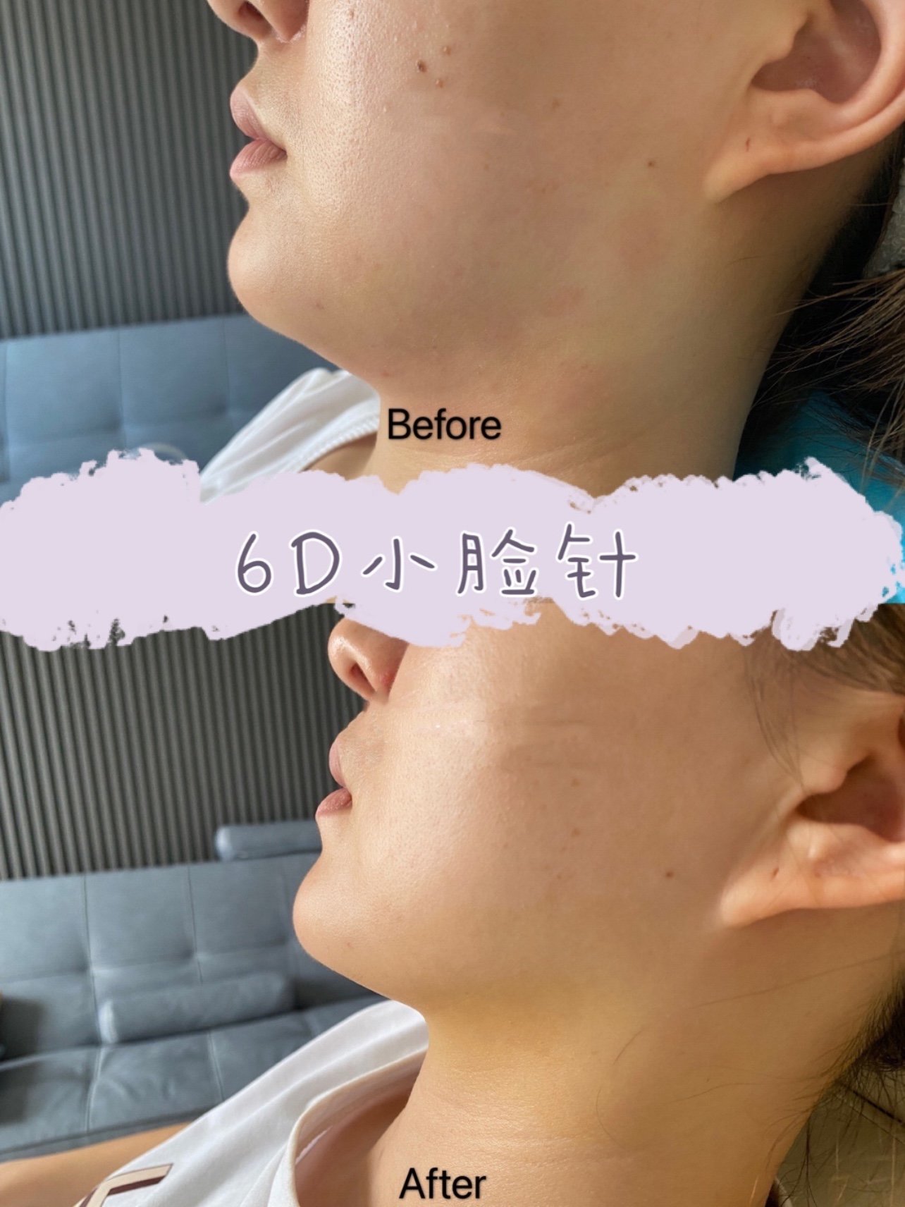 6d小脸针的效果对比图,以前看别人拍侧脸照,清晰的_圈子-新氧美容整形