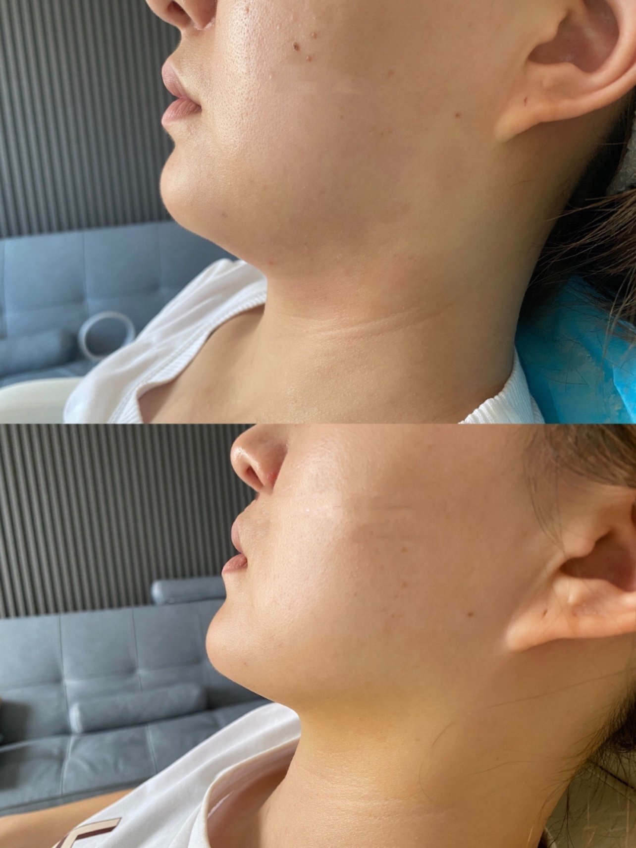 6d小脸针的效果对比图,以前看别人拍侧脸照,清晰的_圈子-新氧美容整形