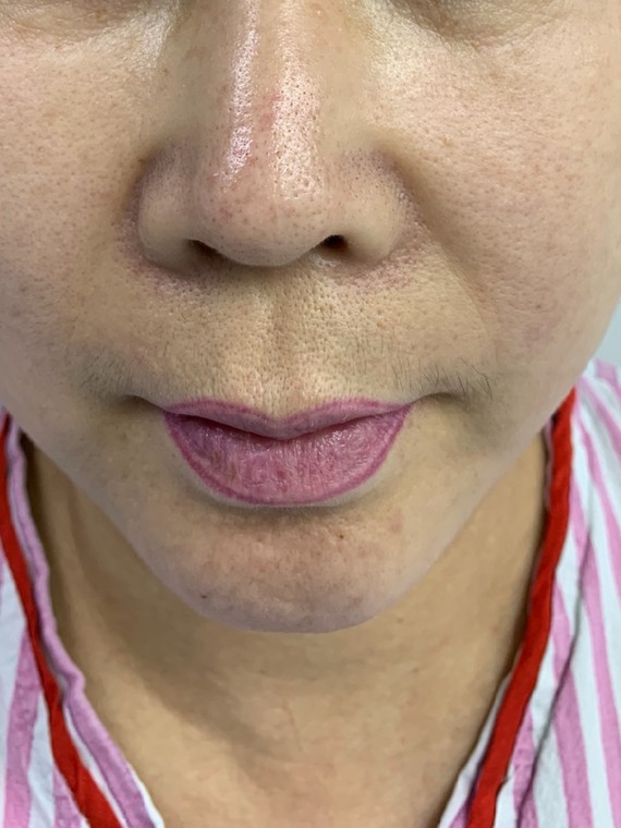 一直都想把人中做一下没有找到合适的医院,通过网络平_圈子-新氧美容