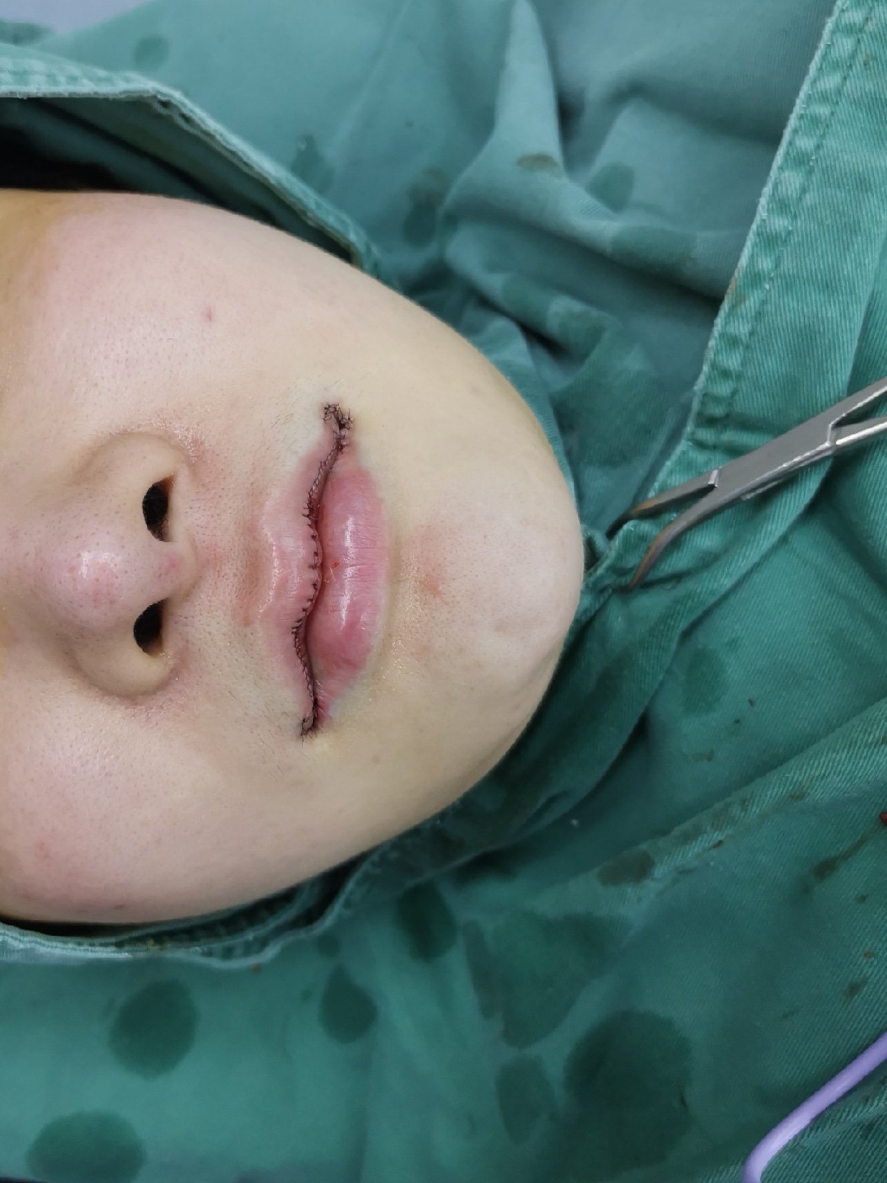 0169♀15完美唇形如何打造,唇手术术后第一天 0969♀_圈子