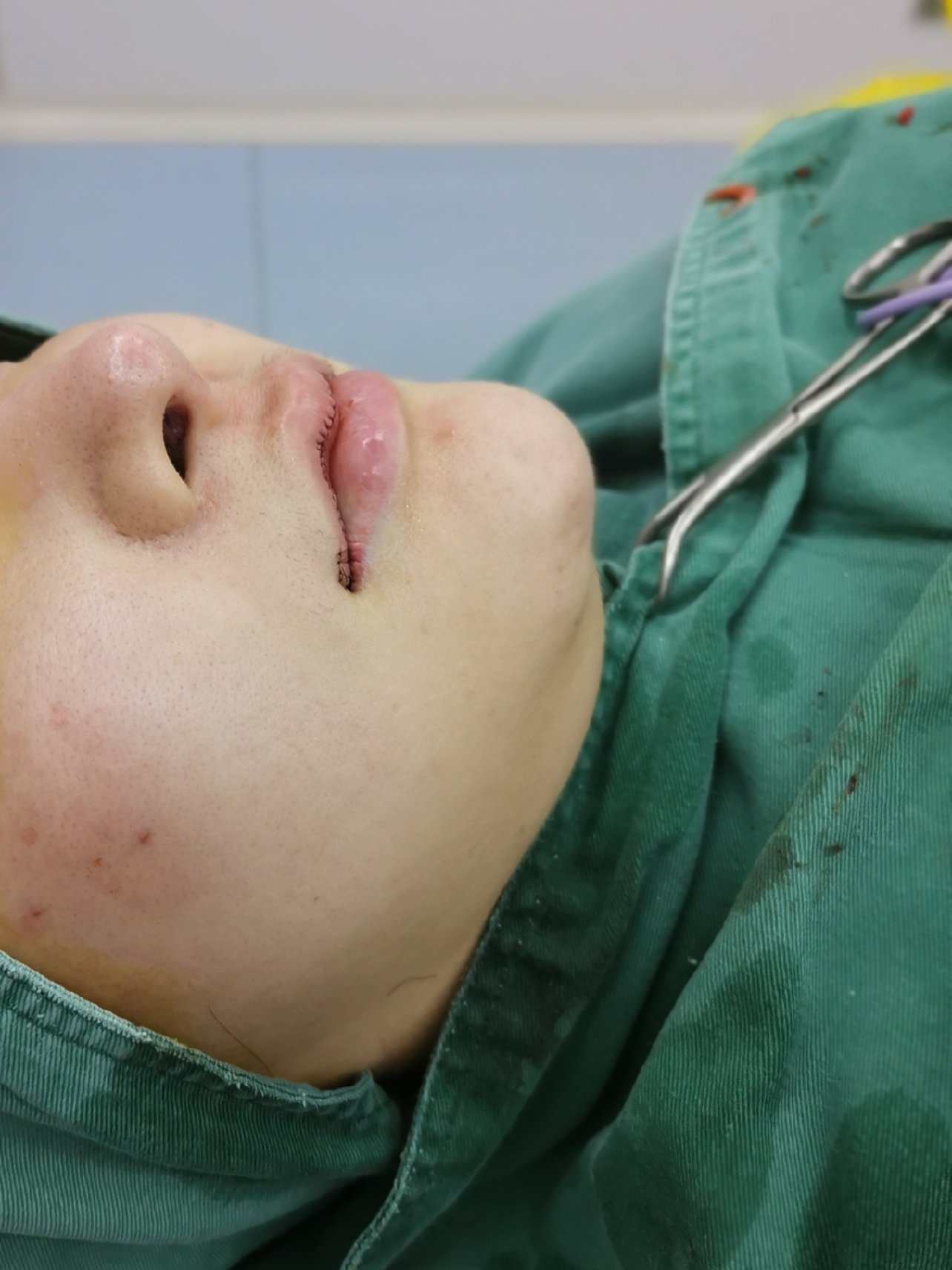 0169♀15完美唇形如何打造,唇手术术后第一天 0969♀_圈子