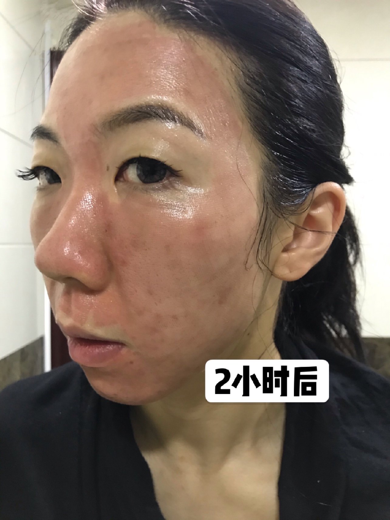 【点阵激光】co2点阵激光 全面部祛痘坑/痘印/痤疮 淡化痘印·抚平