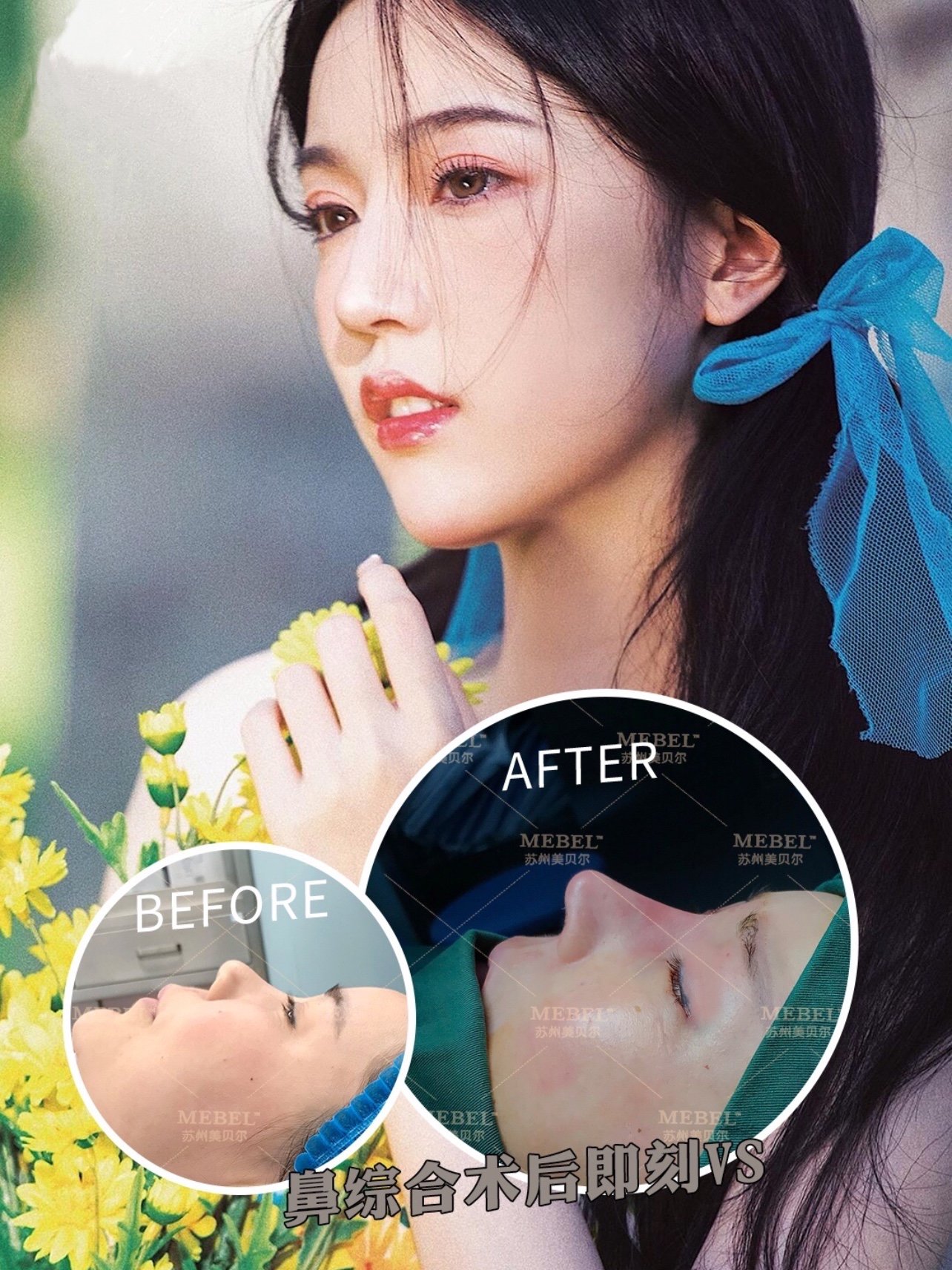 随着整形技术和审美水平的提高,面部美学的分析也越来越精细化,鼻整形