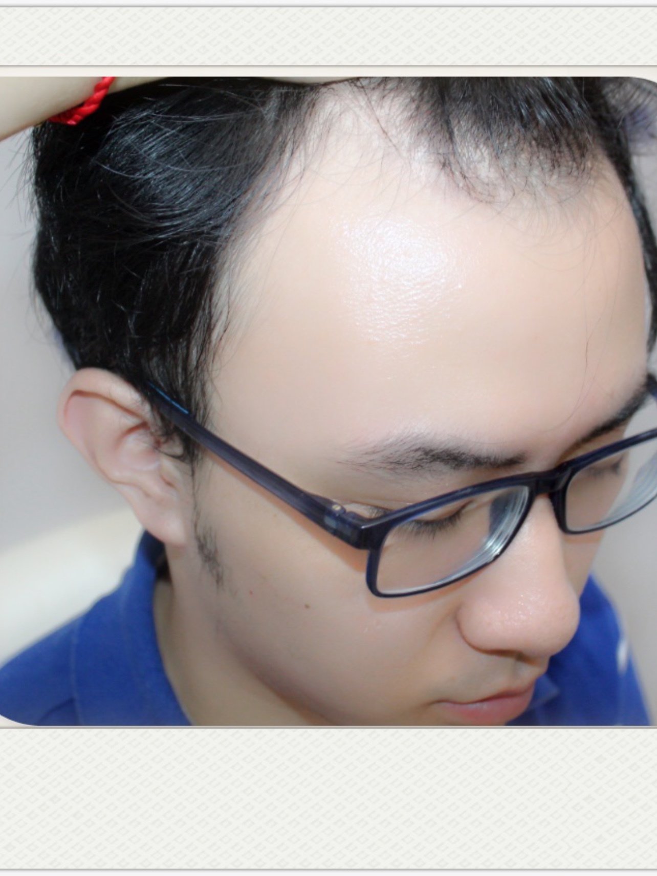 大麦微针植发·术前