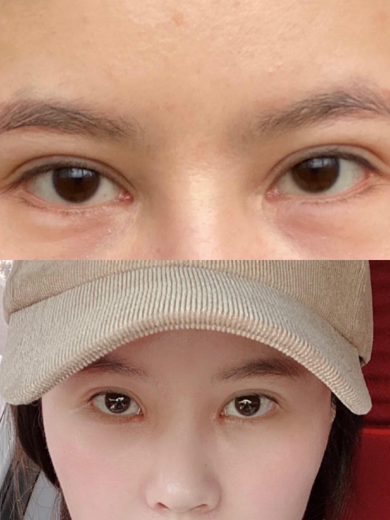 回包了内眼角,疤痕问题也改善了,感觉形状自己还挺满_圈子-新氧美容