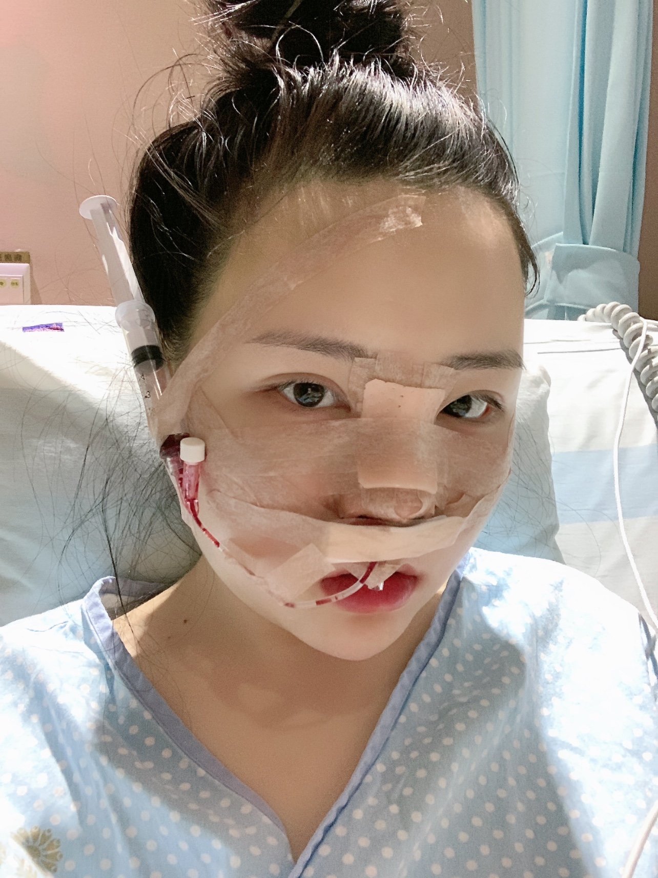 今天是做完肋软骨综合隆鼻手术的第一天,现在还是肿胀_圈子-新氧美容