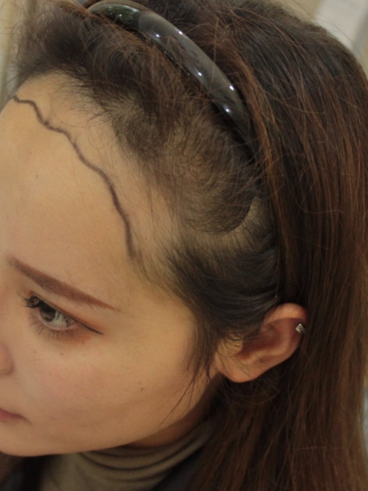 大麦微针植发·术前78157815女生的大额头真的是个麻烦