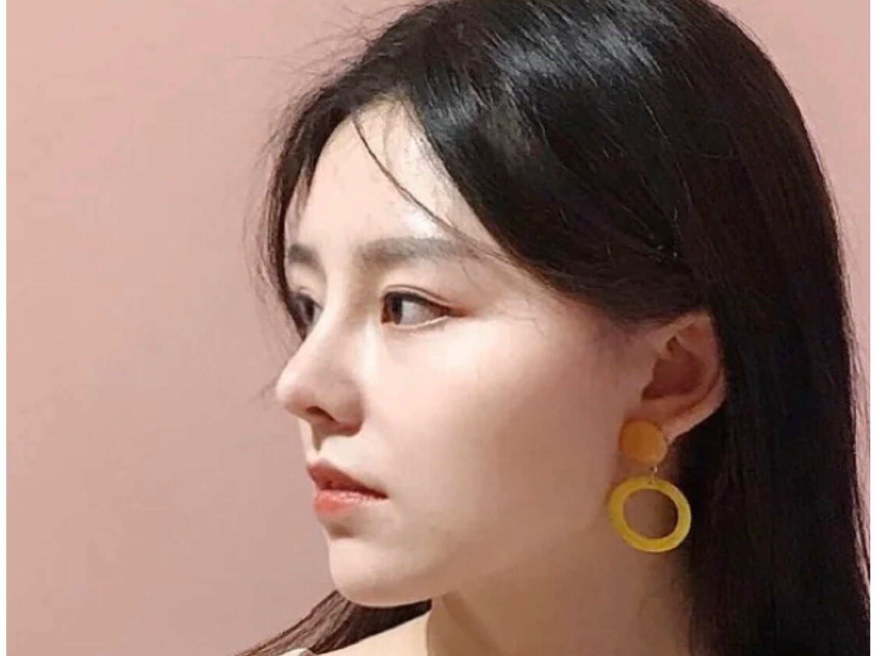 鼻头鼻翼缩小带来精致面容!