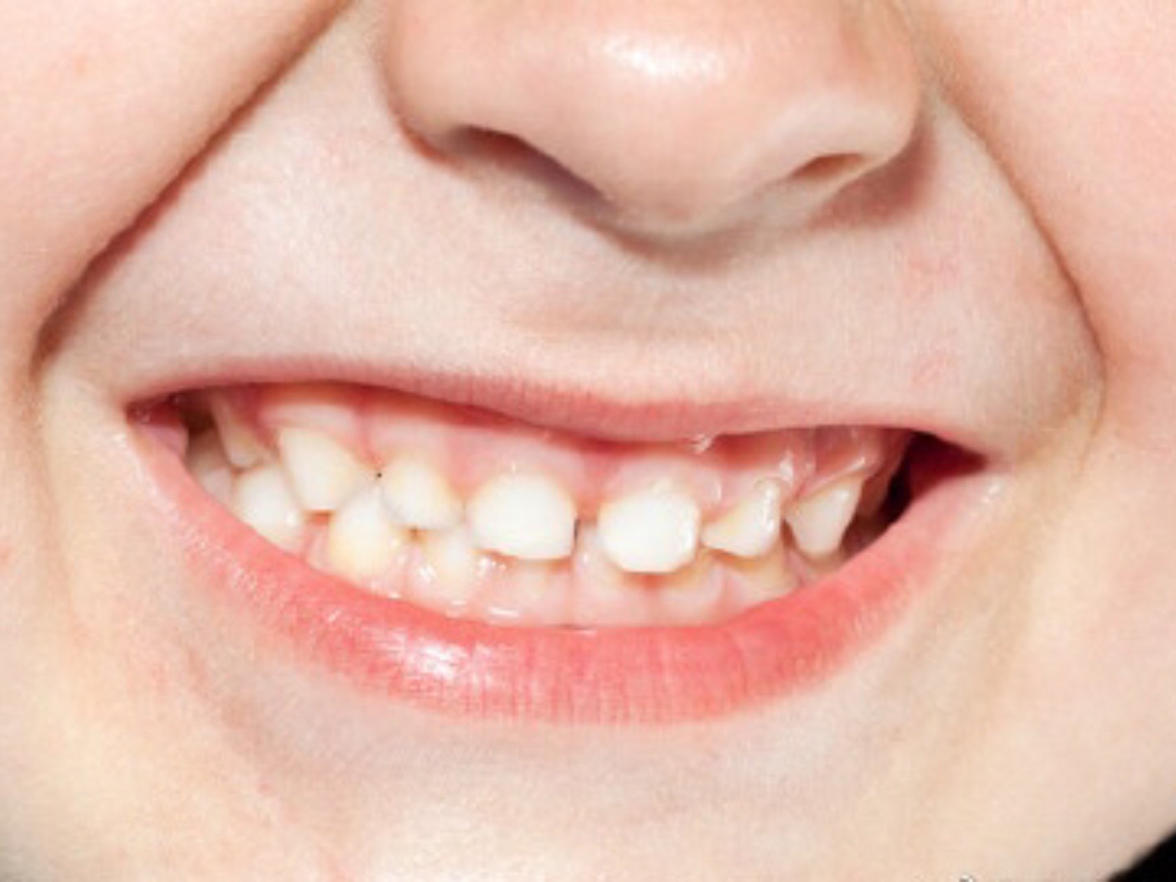 孩子牙缝大是缺钙吗?