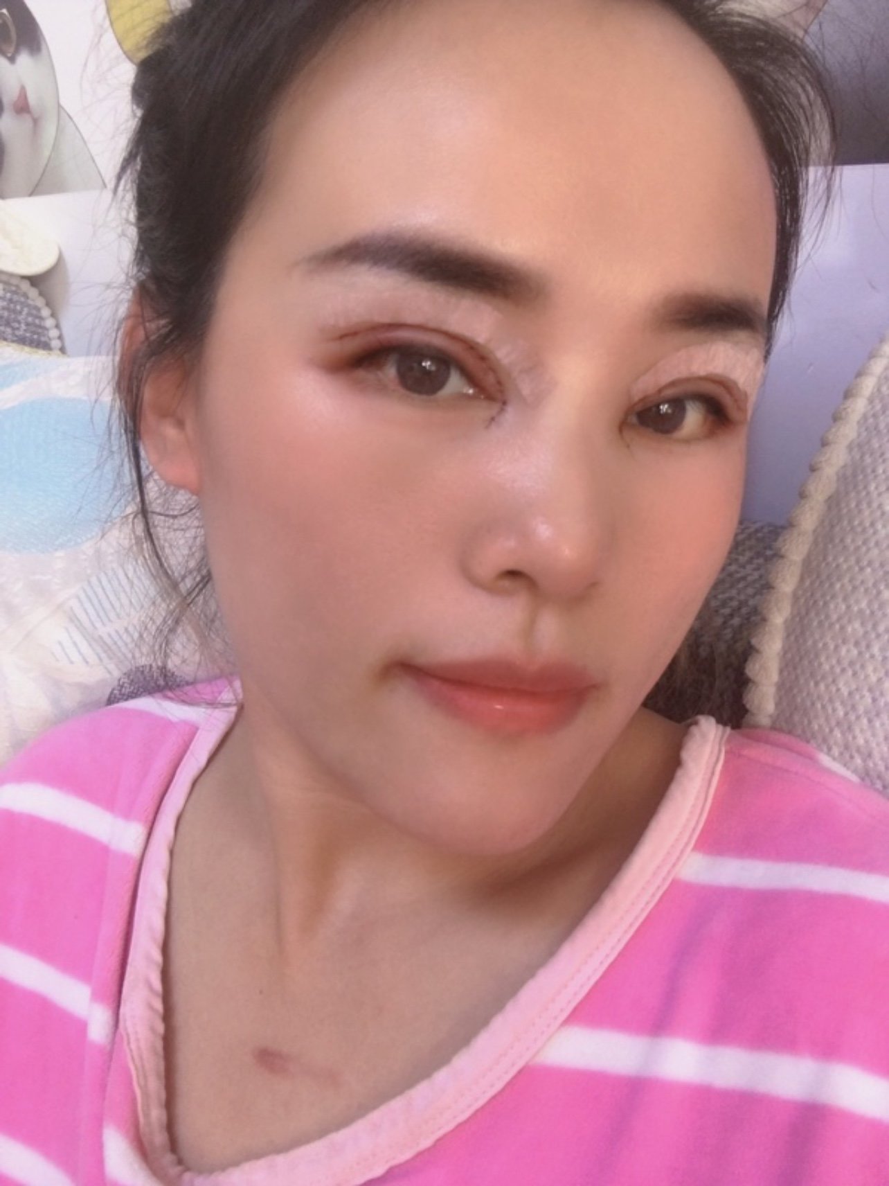 割完双眼皮第2天肿胀期