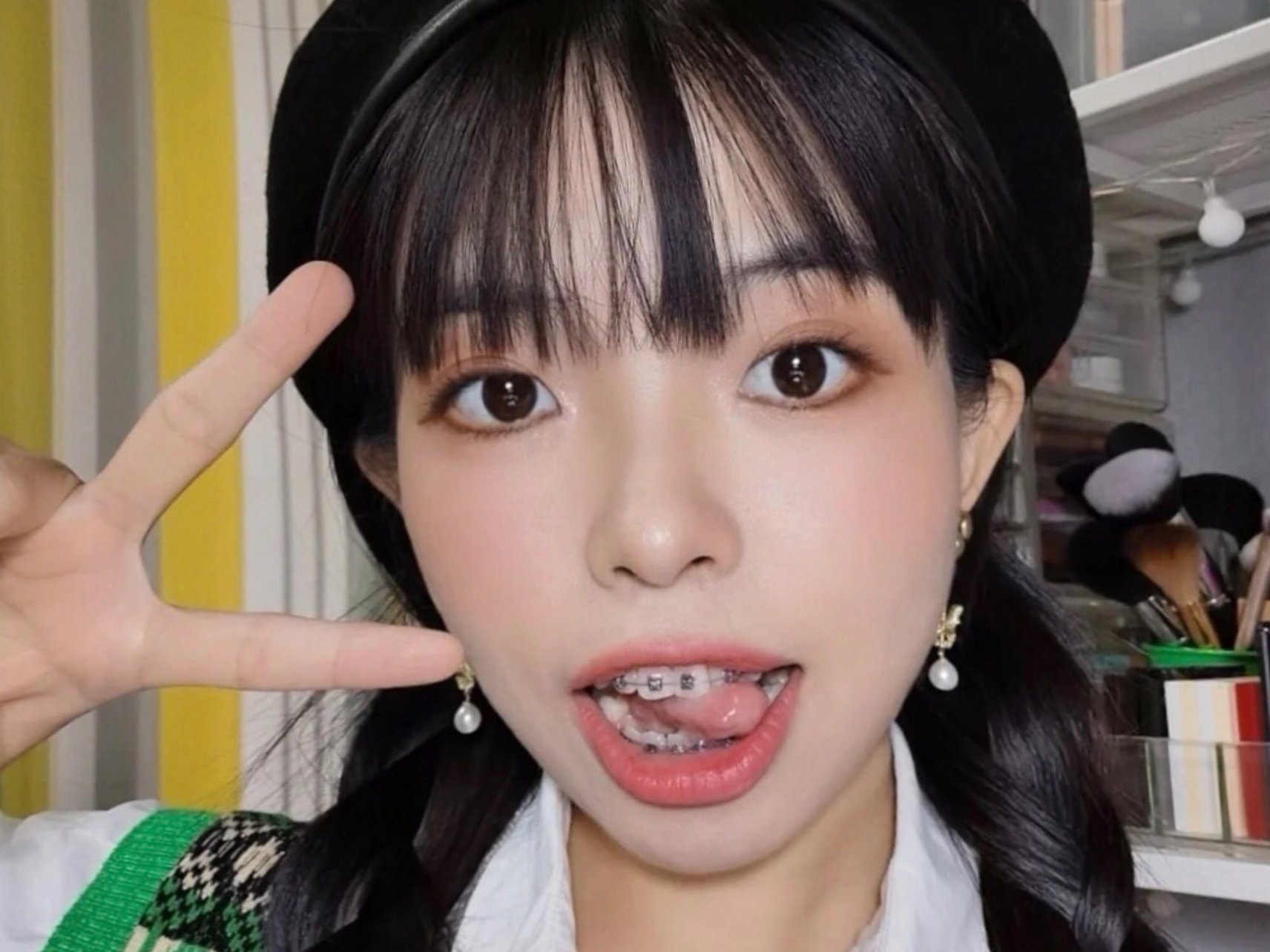 带上了我日思夜想的钢牙哈哈 从高中就很羡慕别人戴牙_圈子-新氧美容