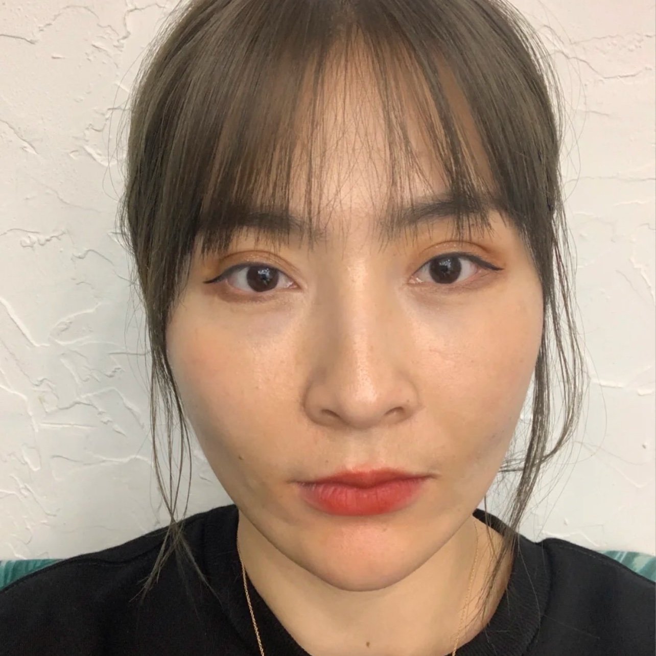 迷你拉皮术后第40天 无美颜分享