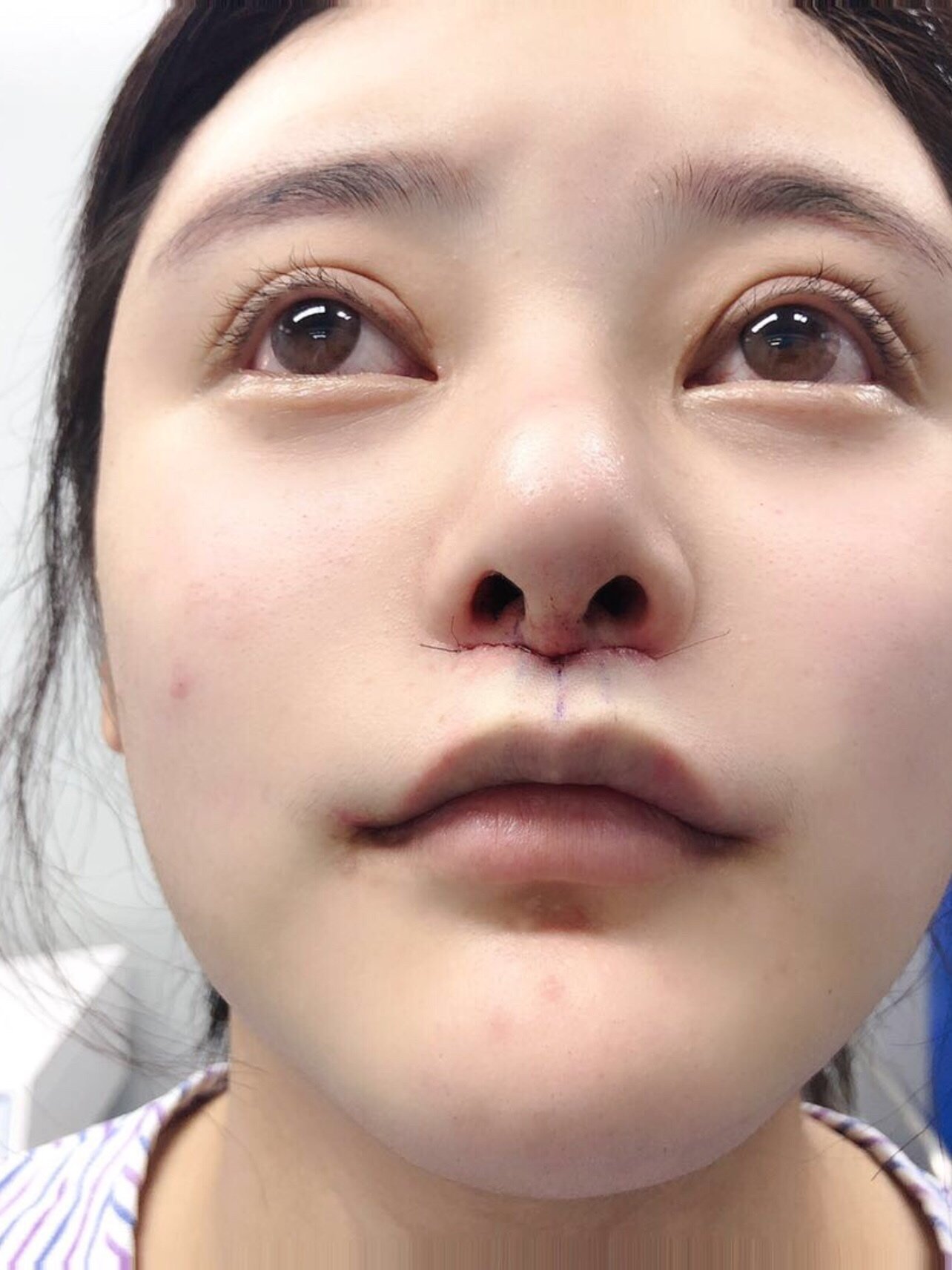 来做了人中的修复~~一年前在上海做的人中缩短,_圈子-新氧美容整形