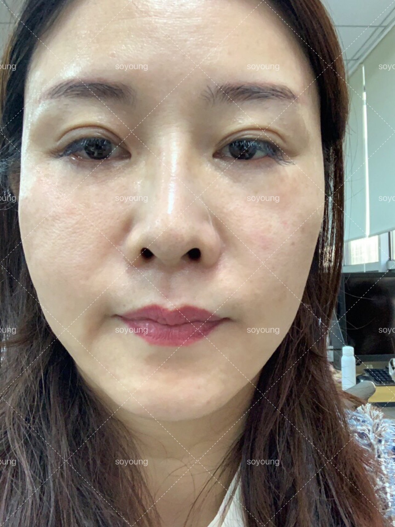 做完光子嫩肤的第一天,效果很不错,我主要是去红血丝_圈子-新氧美容
