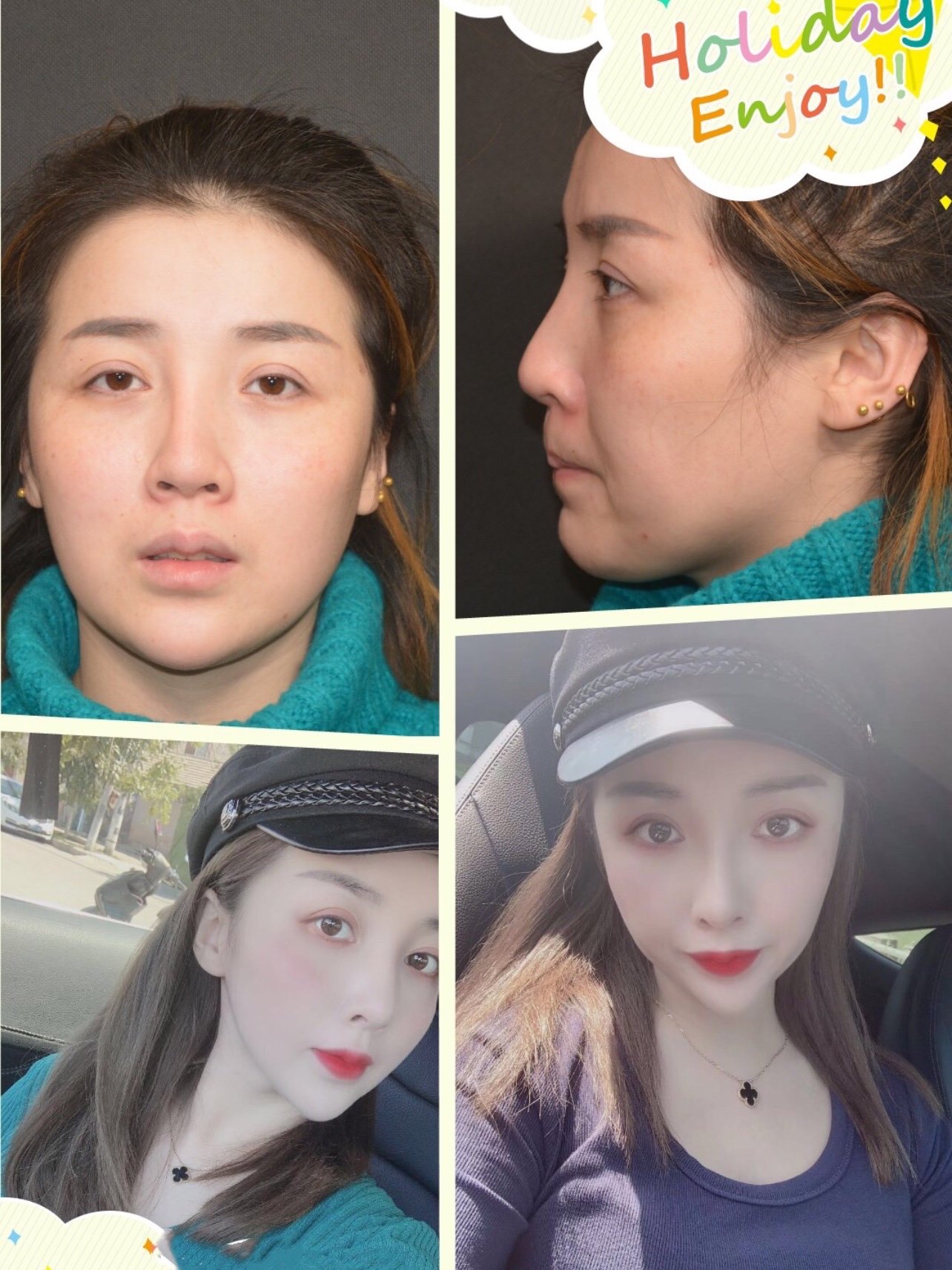 今天分享一个关于硅胶耳软骨隆鼻的失败案例看李劲良院长如何拯救姑娘