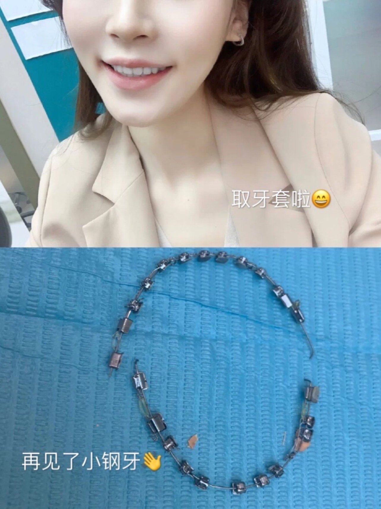 嘴凸正畸两年终于摘牙套了!