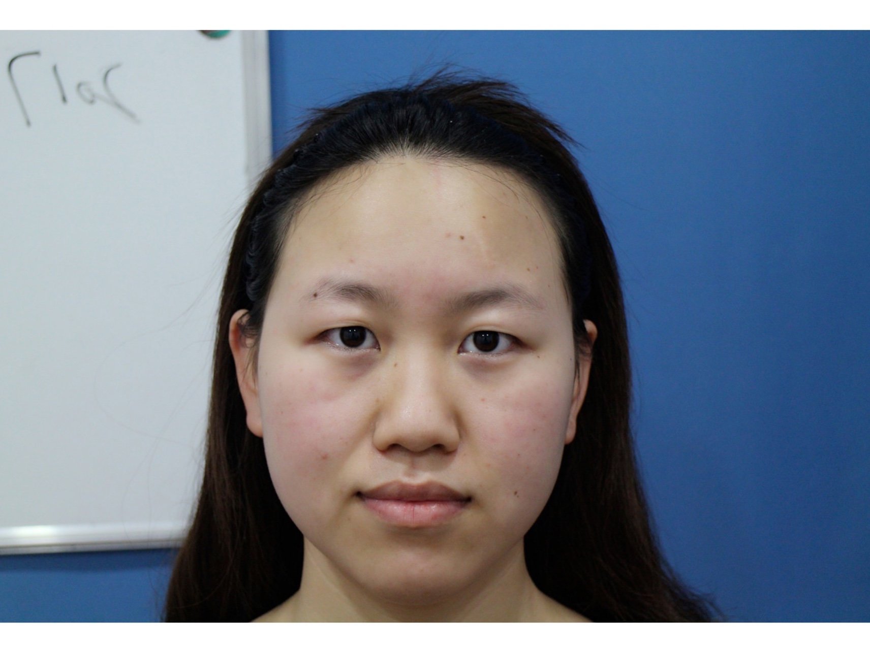 天生肿泡眼,内双,眼睛很垮,感觉老了好多岁,真的很_圈子-新氧美容整形