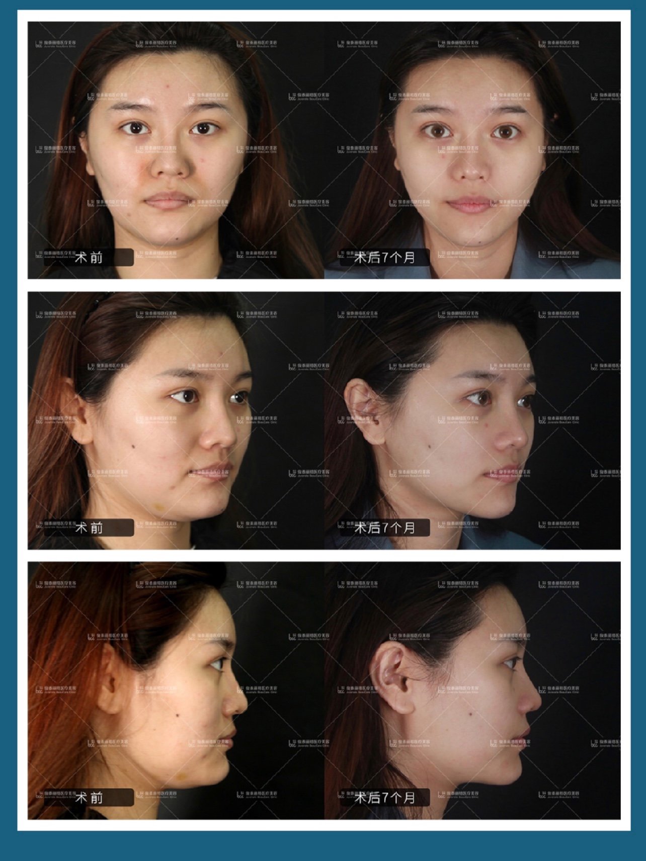 膨体鼻基底填充