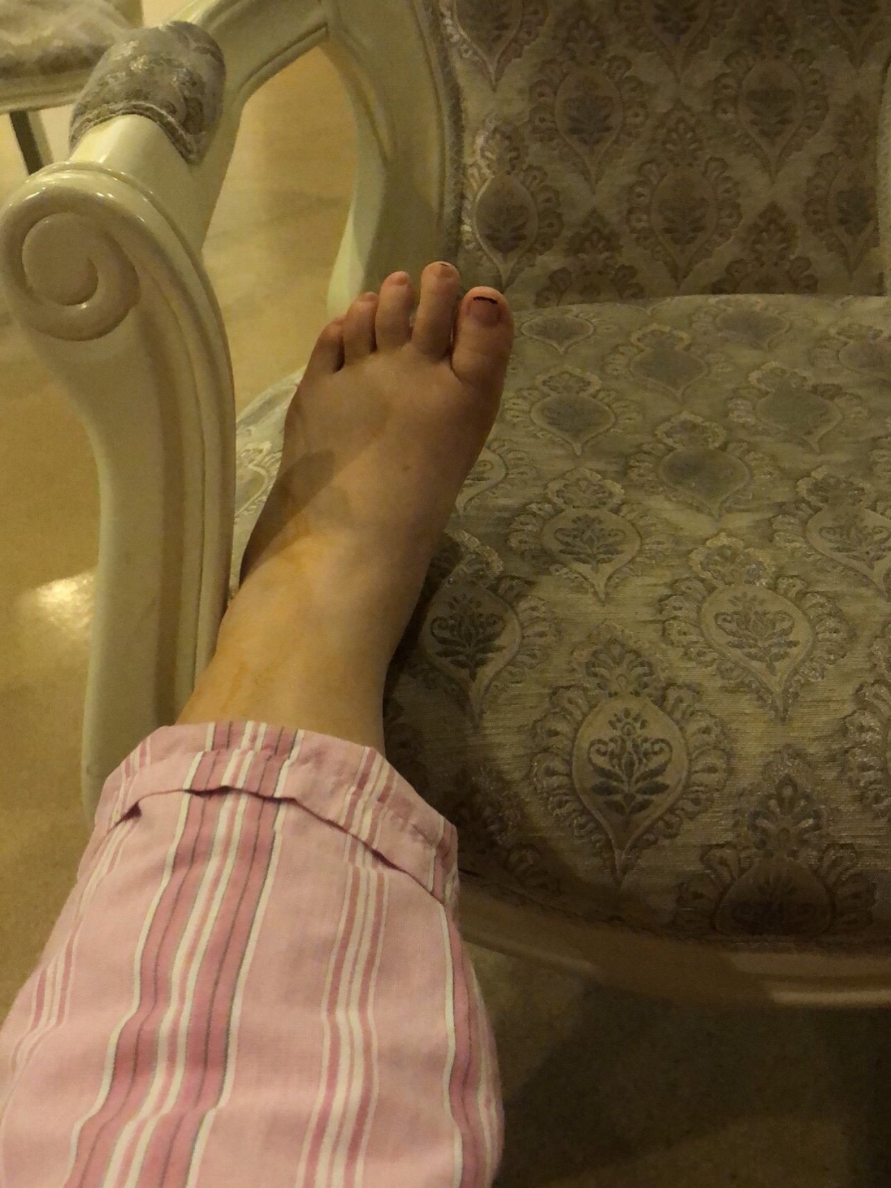 刚做完手术的第二天,也不知道以后什么效果,现在整腿_圈子-新氧美容