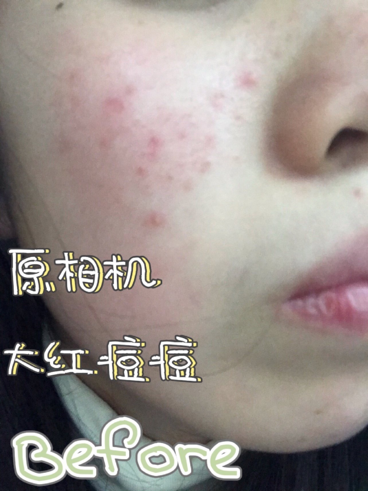 9090pmpm水杨酸棉片～分享我的战痘经验刷酸神器敏_圈子-新氧美容