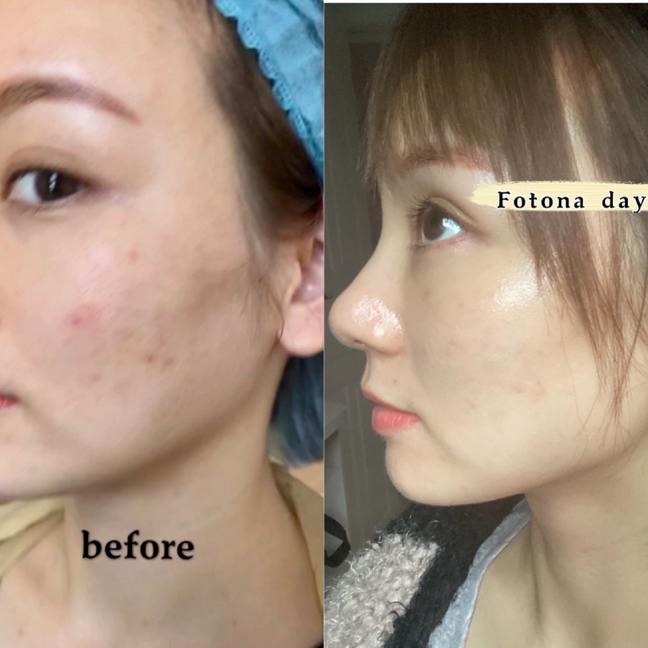 fotona欧洲之星七天对比