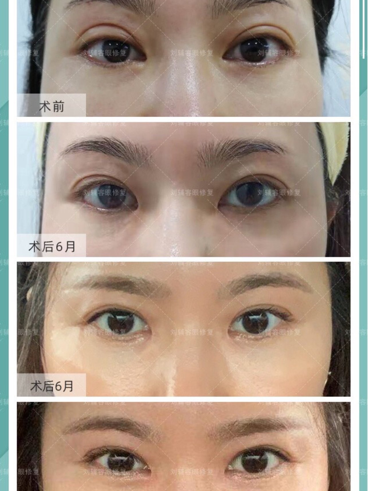 刘辅容内眼角修复案例分享
