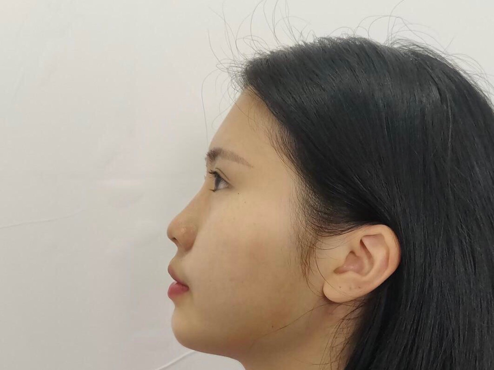 术前看得出来是一个塌塌鼻,术后就是一个精致的小挺鼻_圈子-新氧美容