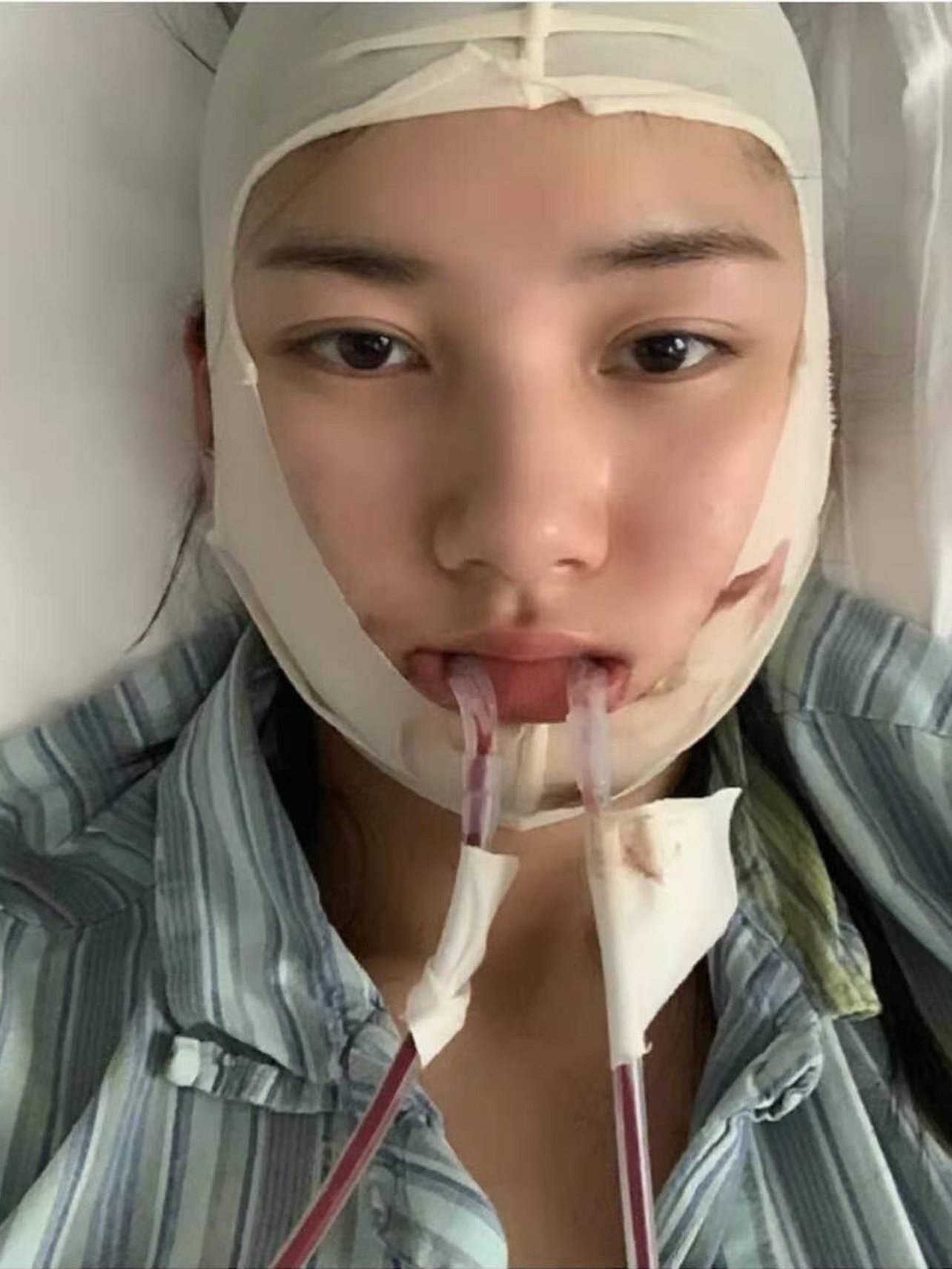 下颌角截骨,改变了我的整个人生