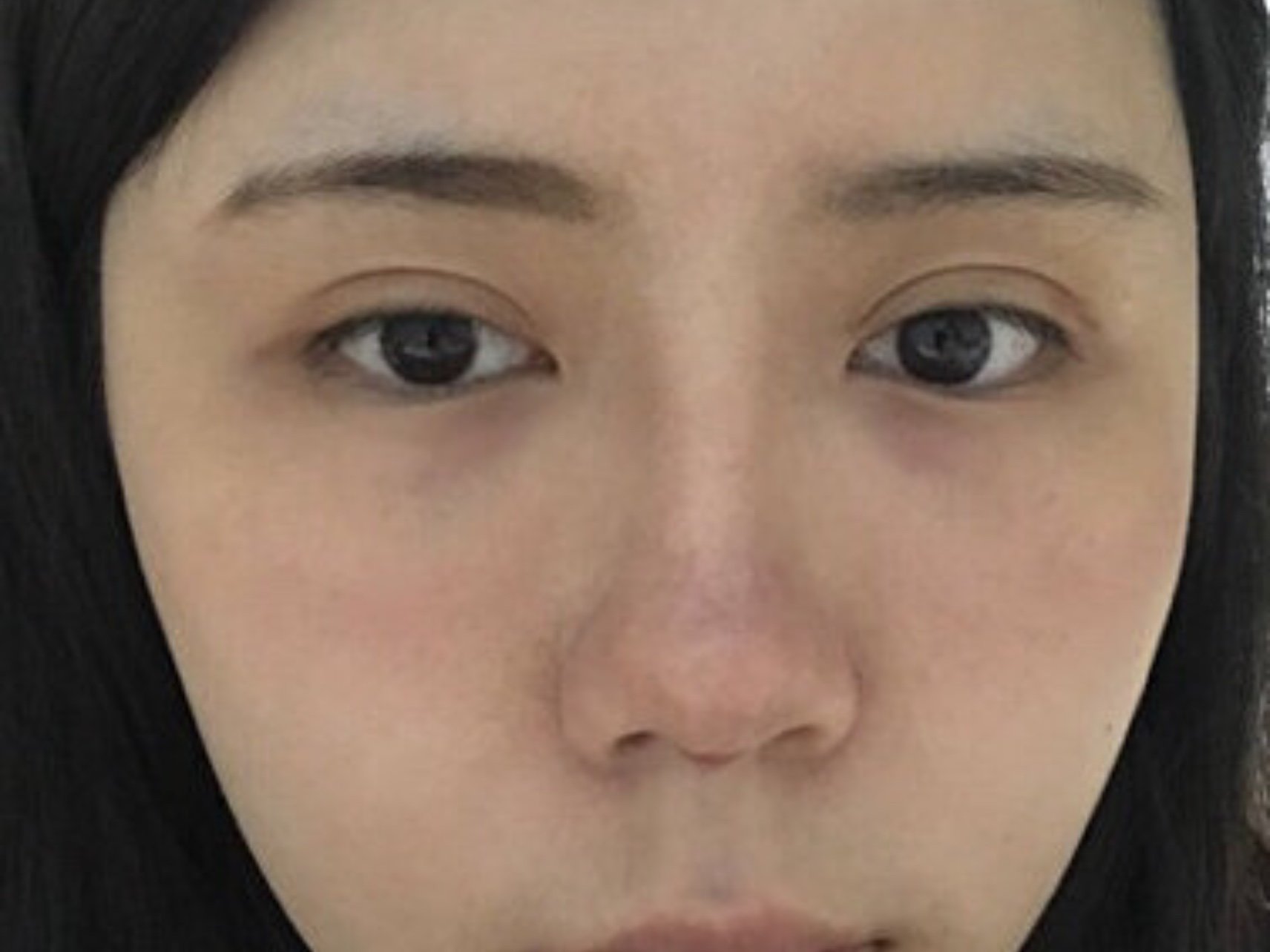 年纪轻轻却有了法令纹,这个法令纹就是鼻子凹陷照成的_圈子-新氧美容