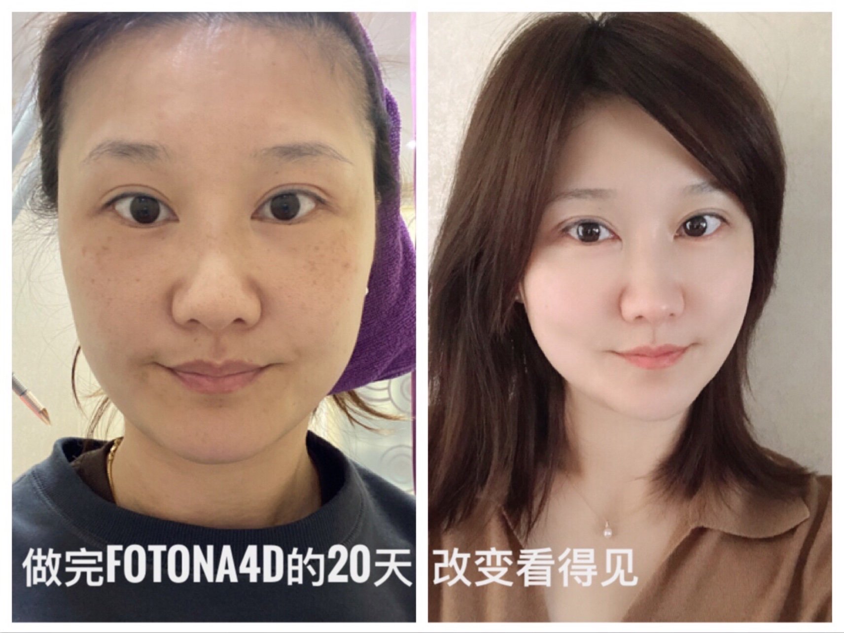 题,我建议选择 fotona4d 去年做了线雕,线雕侧重「整体抗衰」 适用于