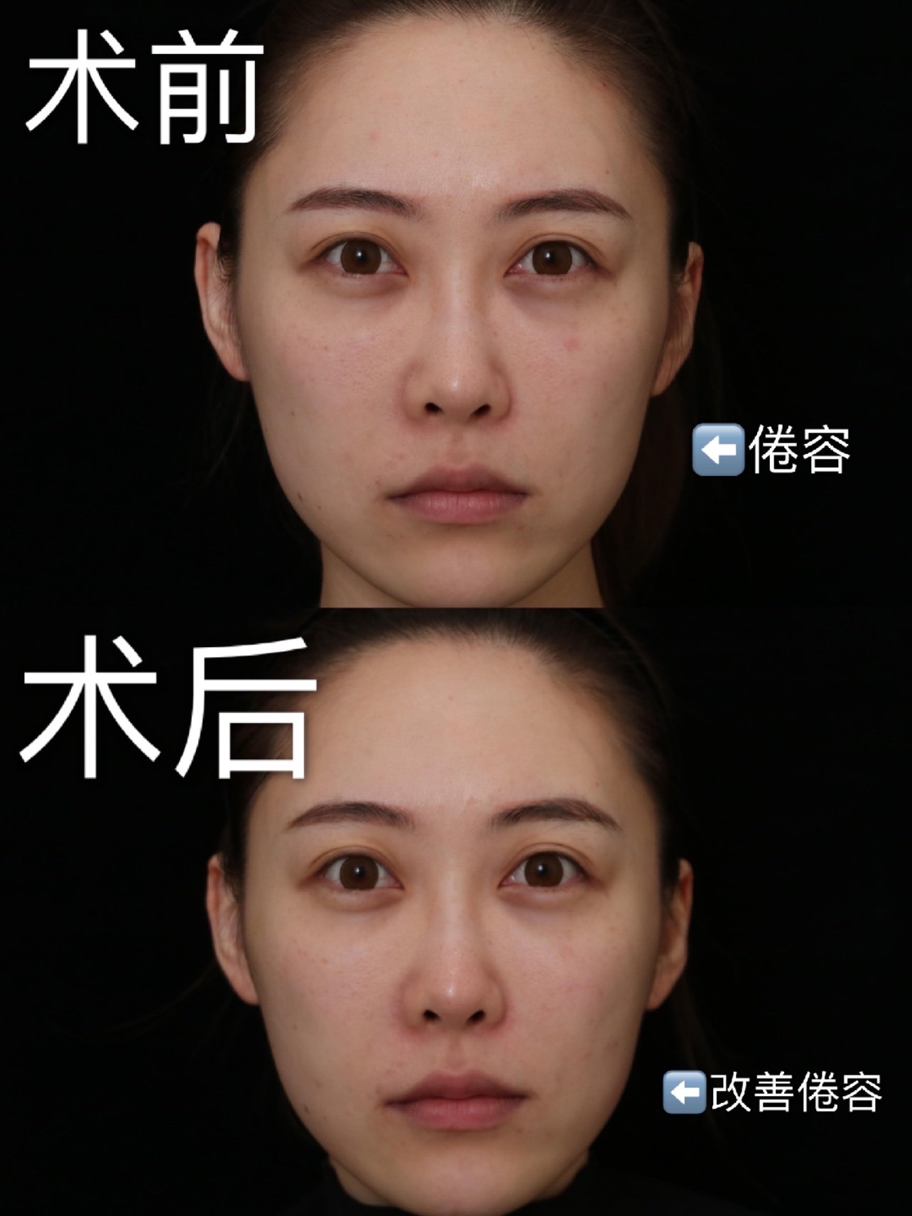 进行脸部微调96159615有"微调"_圈子-新氧美容整形