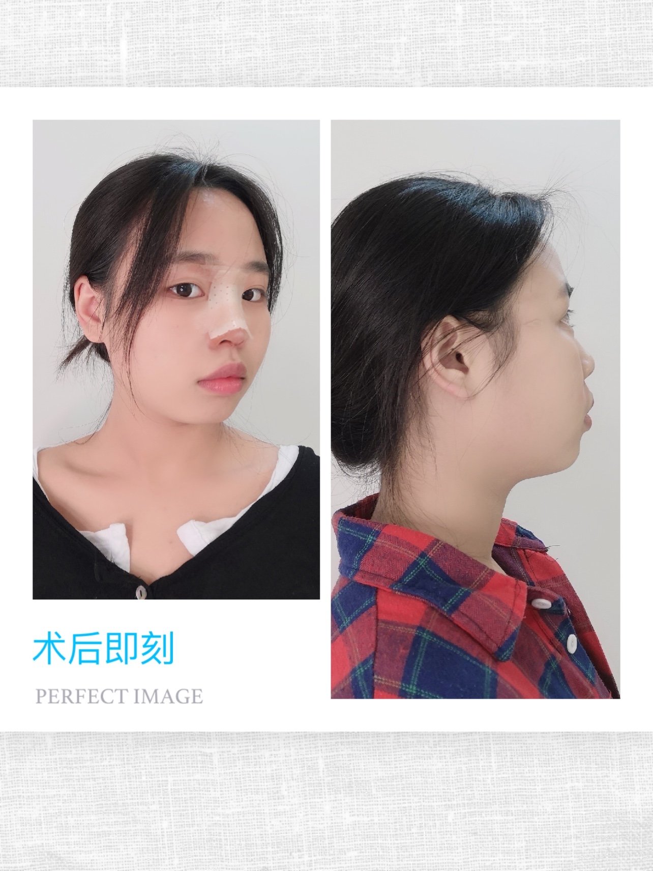 我是属于鼻子本身非常的塌陷,无论正面侧面都看不出鼻梁,而且鼻翼的