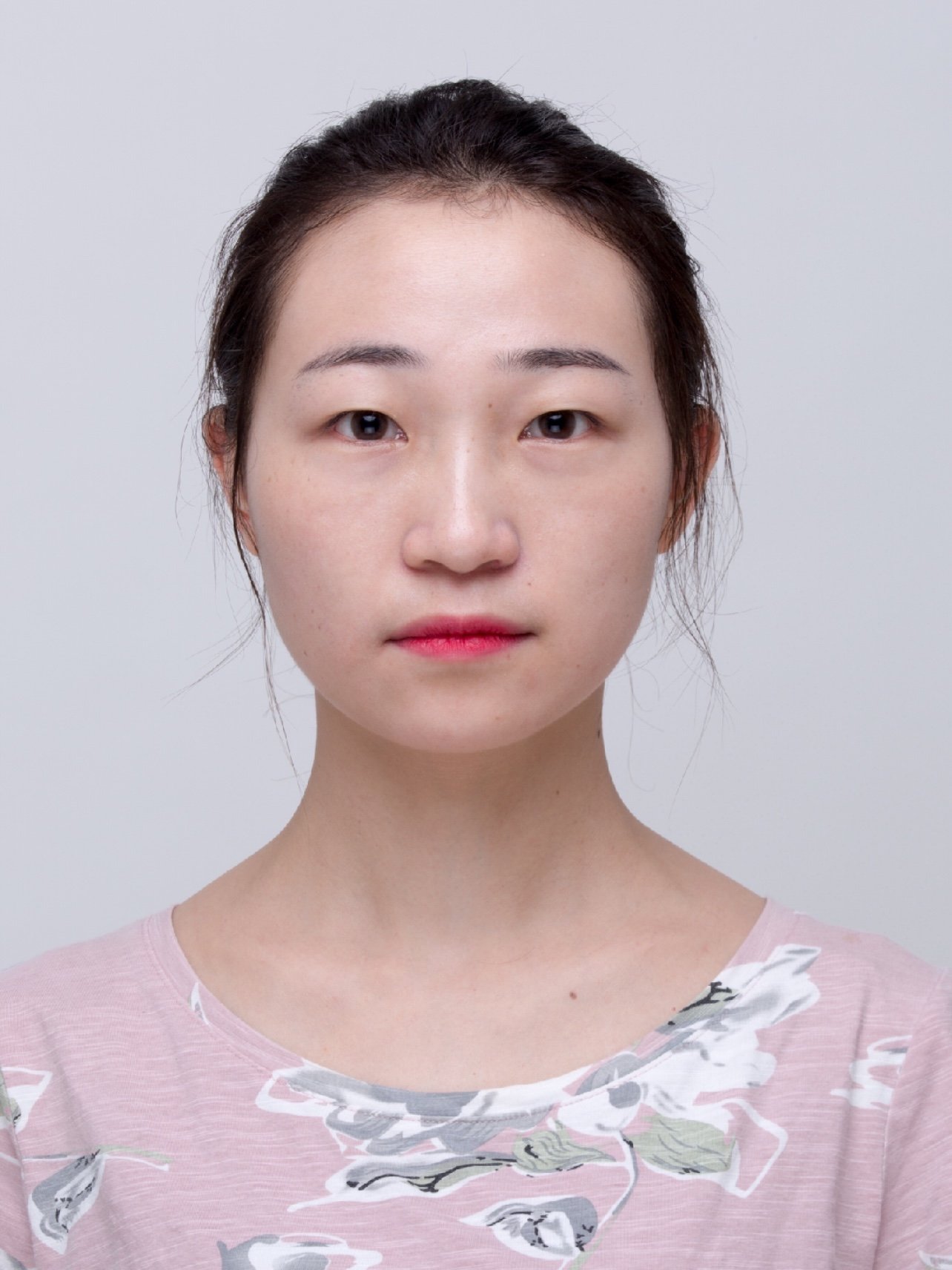 90术前分析:典型的单眼皮,伴随着内眦赘皮明显,眼尾_圈子-新氧美容