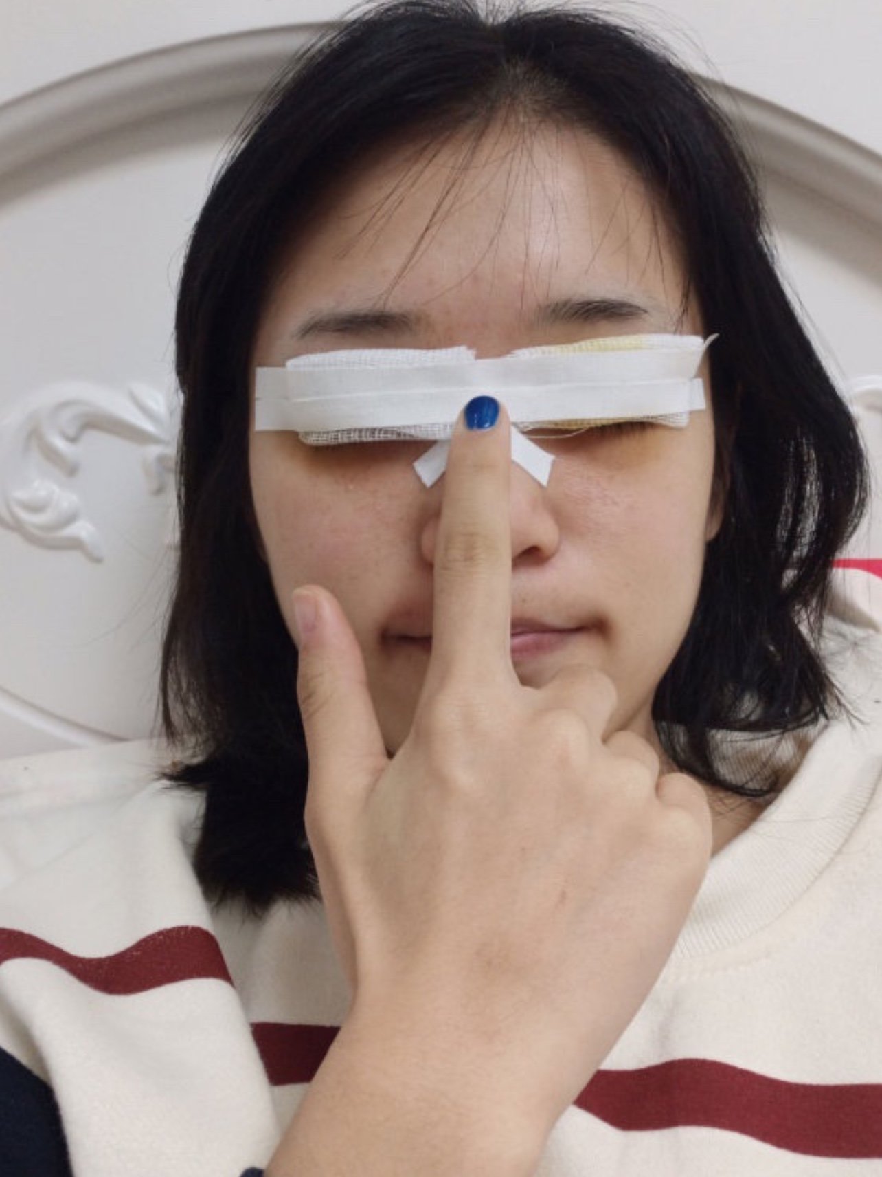 也就术后第一天眼睛上裹着纱布有点遮瞳不方便,对于饮_圈子-新氧美容