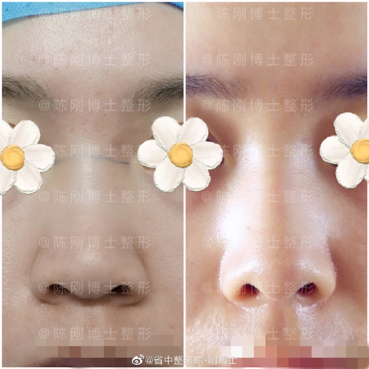 鼻案例耳软骨加筋膜隆鼻术后1月