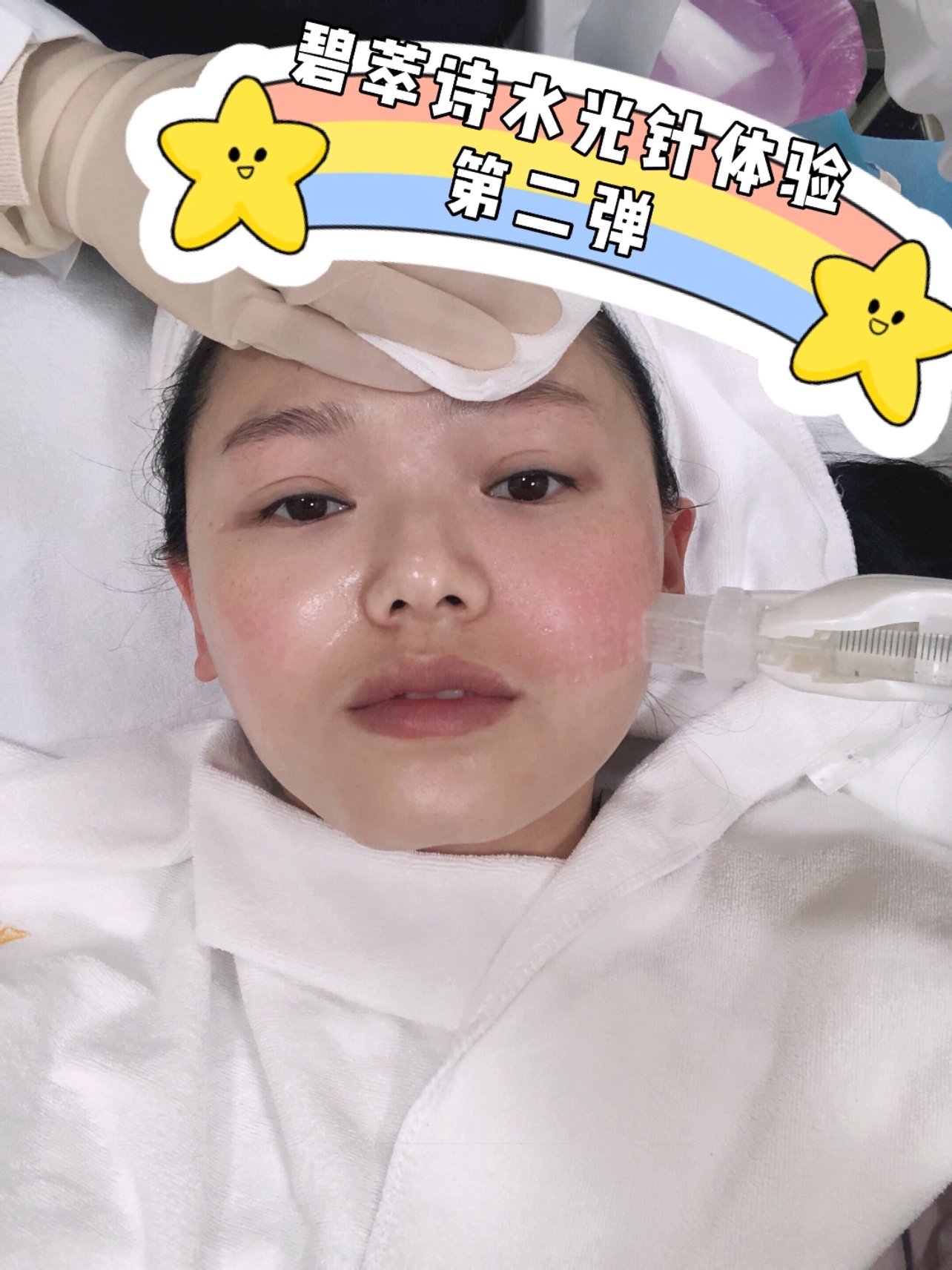 02打完水光针已经第五天了