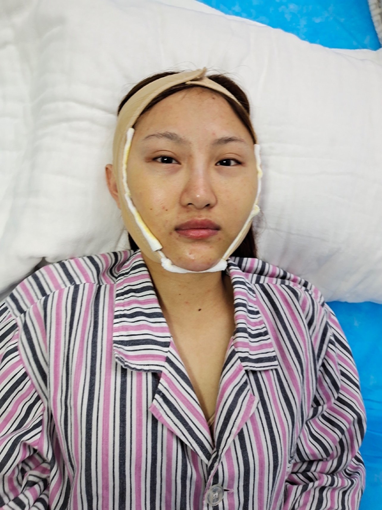 手术项目下颌角截骨