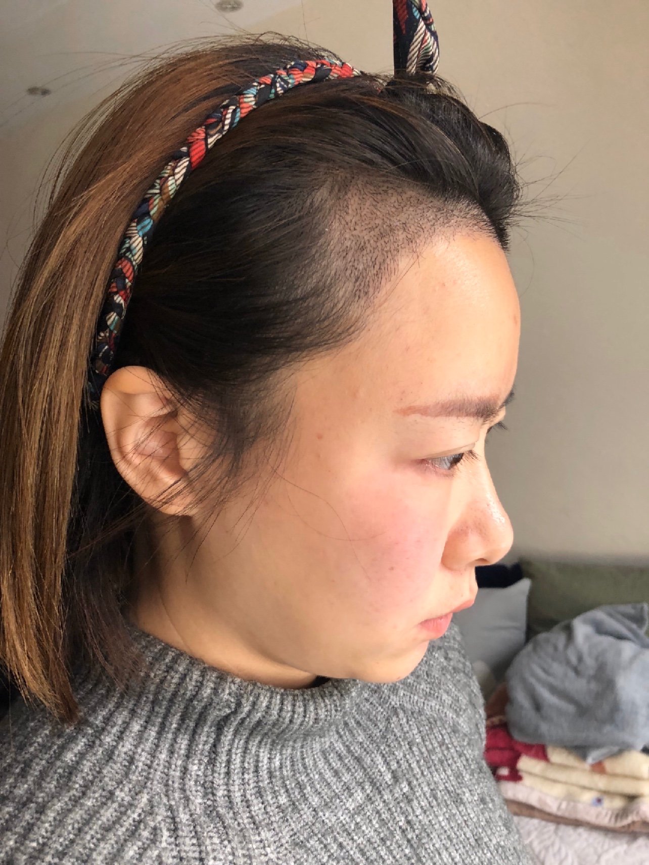 【种植发际线】2000单位 百龄艺术植发 美学设计 修饰轮廓