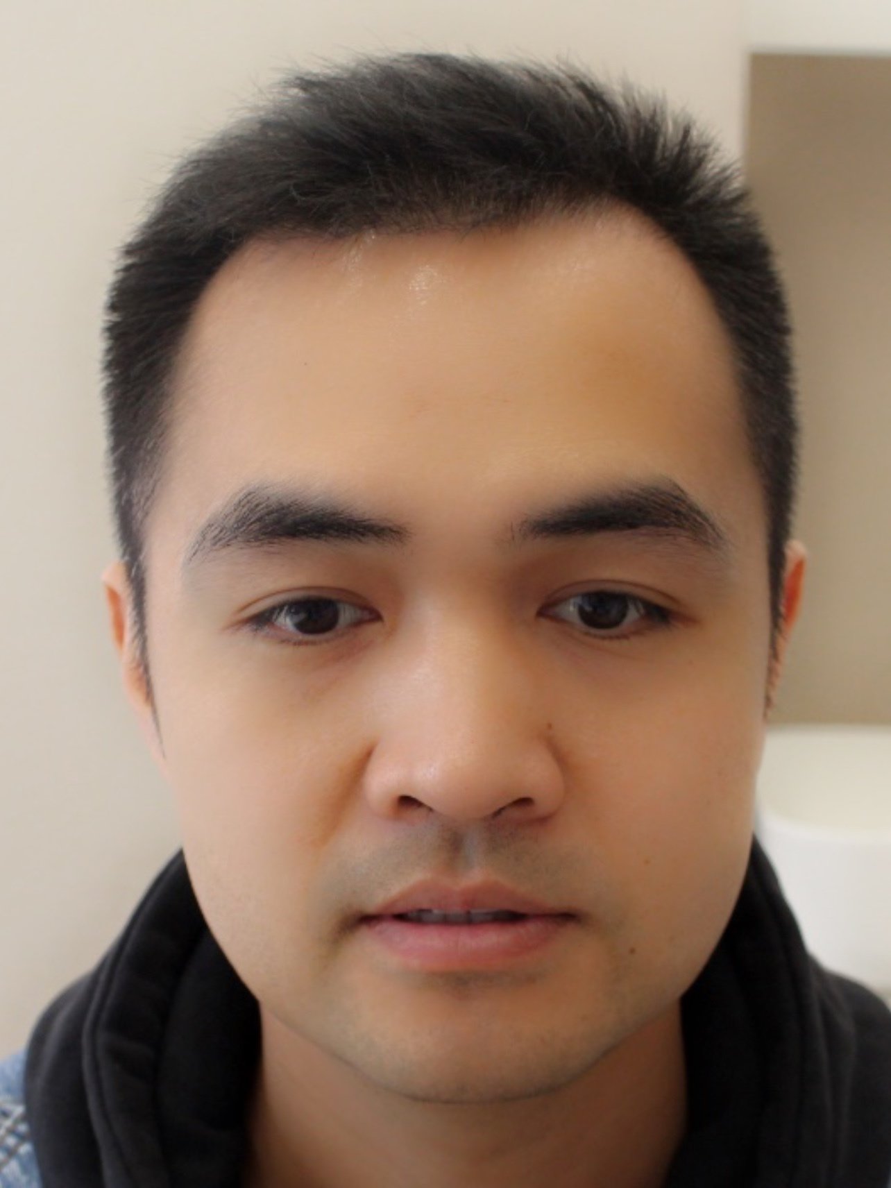 见头皮了,前额的头发也长得很好,以前凹进去的两个额角已经缓冲了很多