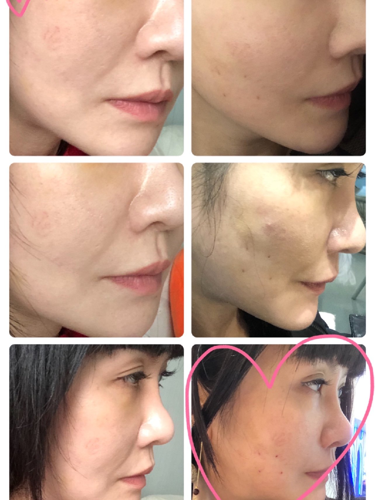 术后一周之后,提升效果非常明显,照片完全没有任何p,清晰可见的鲜明