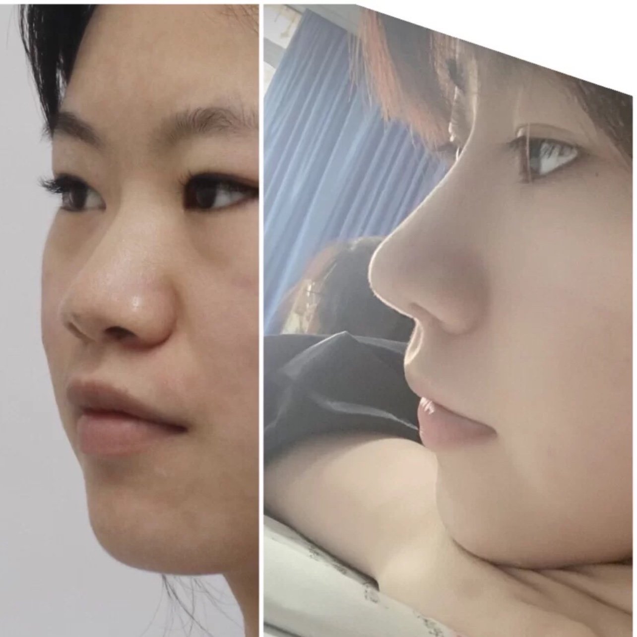 隆鼻 鼻基底,除了鼻子好看了之外,意外收获是嘴凸现_圈子-新氧美容