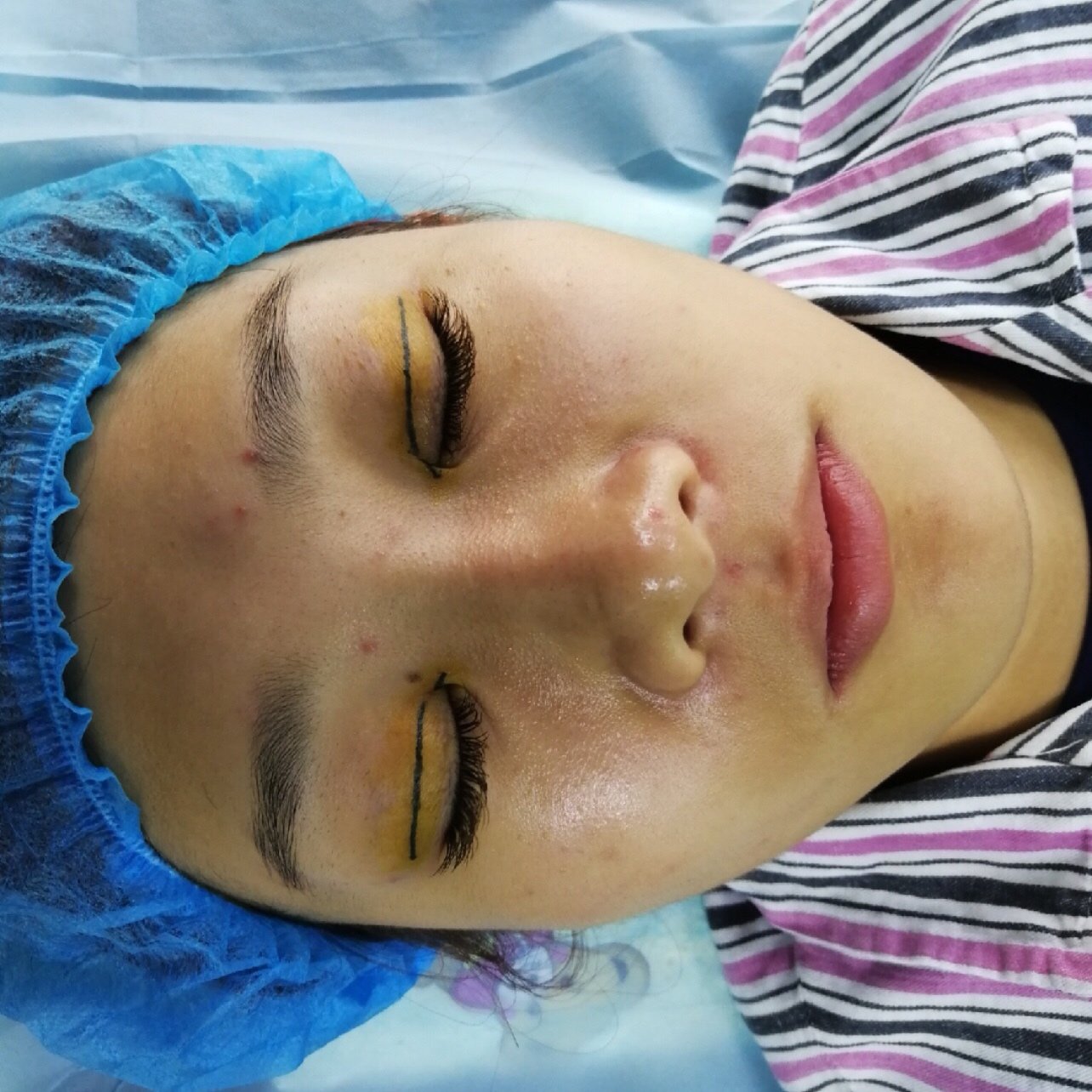 在上海盈美找马主任做的埋线双眼皮和内眼角手术,术前_圈子-新氧美容