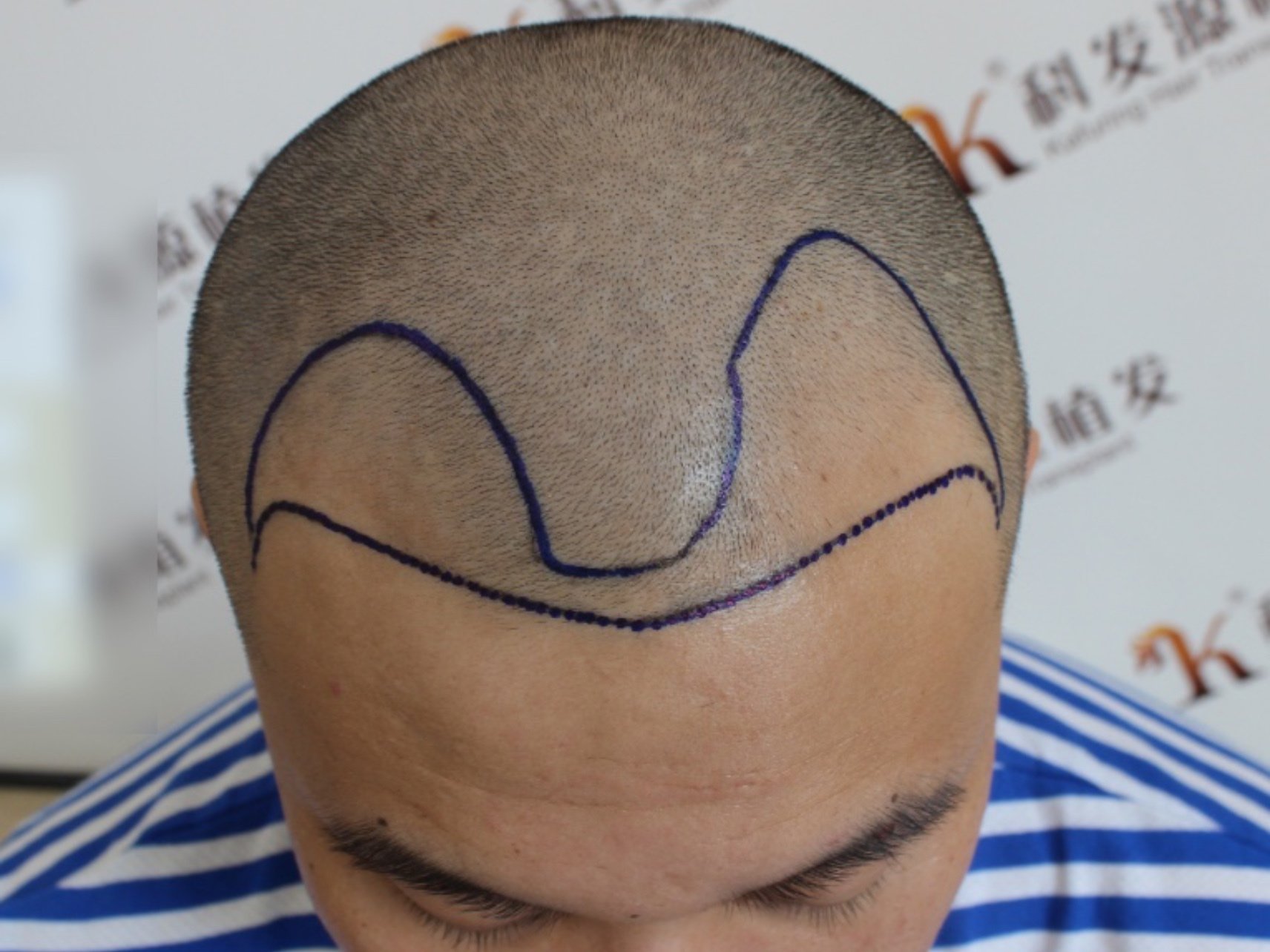 大麦微针植发·术前9494植发之前对于自己的脱发已经有_圈子-新氧