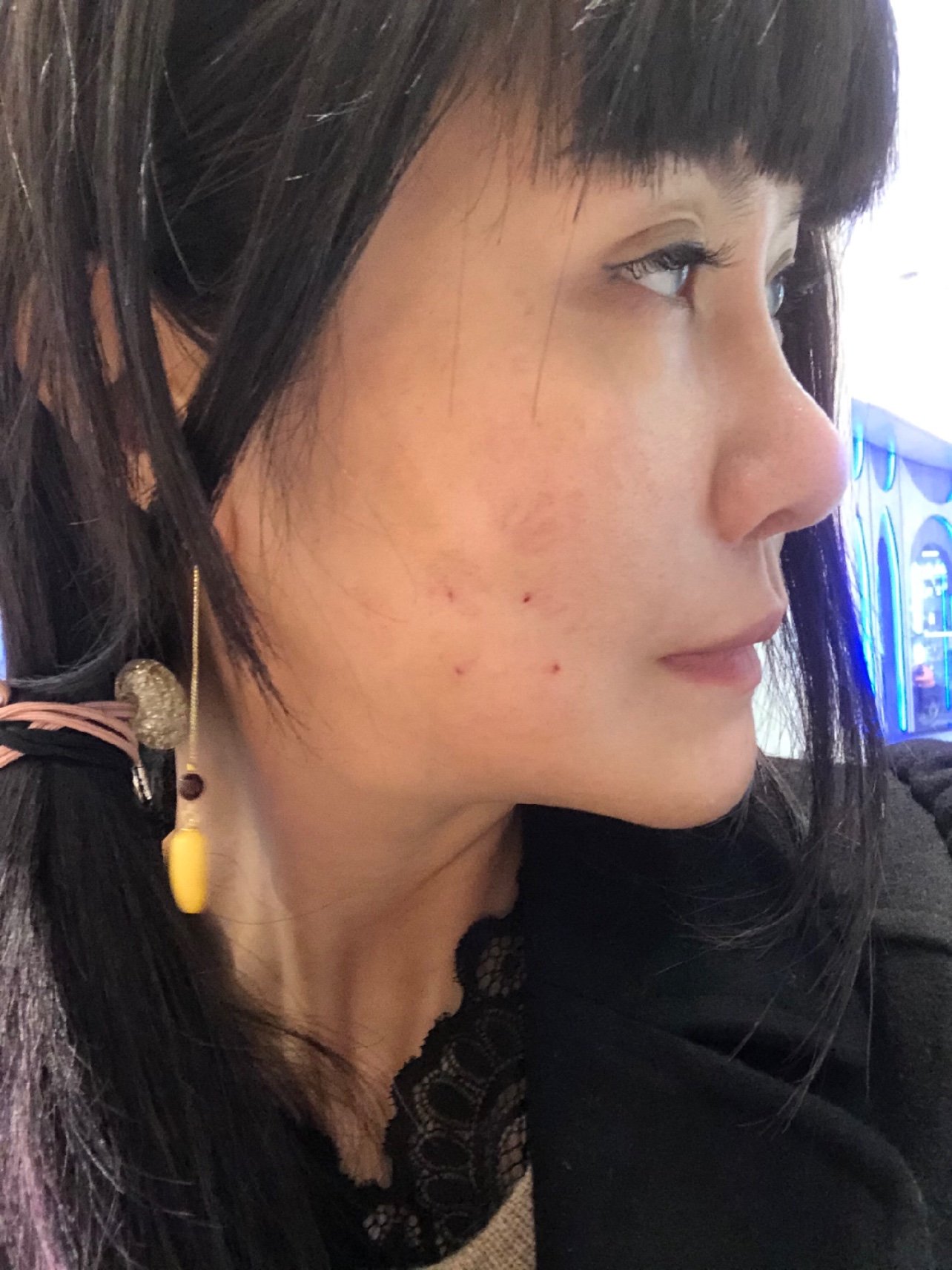 术后一周之后,提升效果非常明显,照片完全没有任何p,清晰可见的鲜明