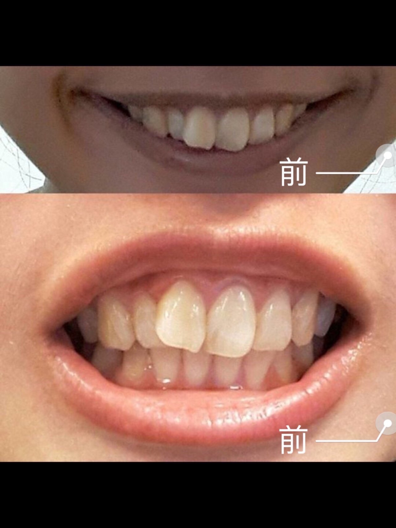 坐标:四川成都总费用:1w 时间:1年半时隔一年半_圈子-新氧美容整形