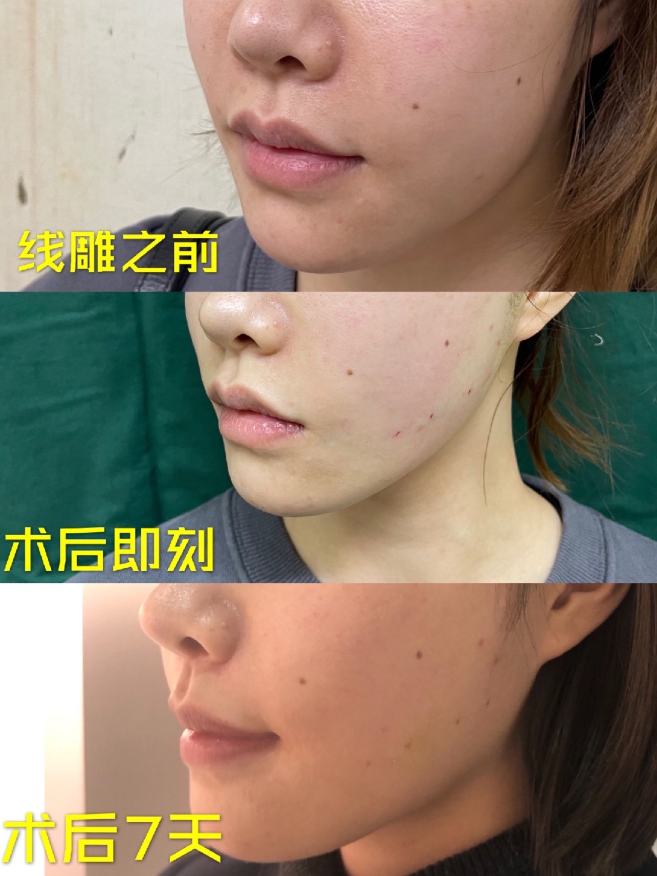 大家好我是小诺～时间过的飞快,转眼间线雕手术就过了10天了.