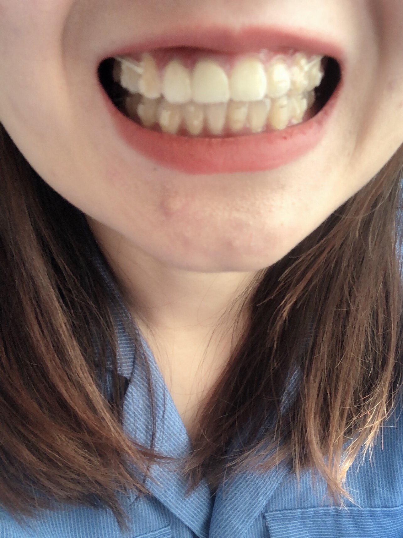 30今天是我戴牙套的409_圈子-新氧美容整形