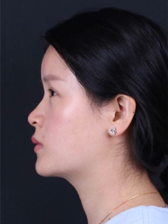 没有想到玻尿酸垫下巴的效果这么的好,又自然又好看,_圈子-新氧美容