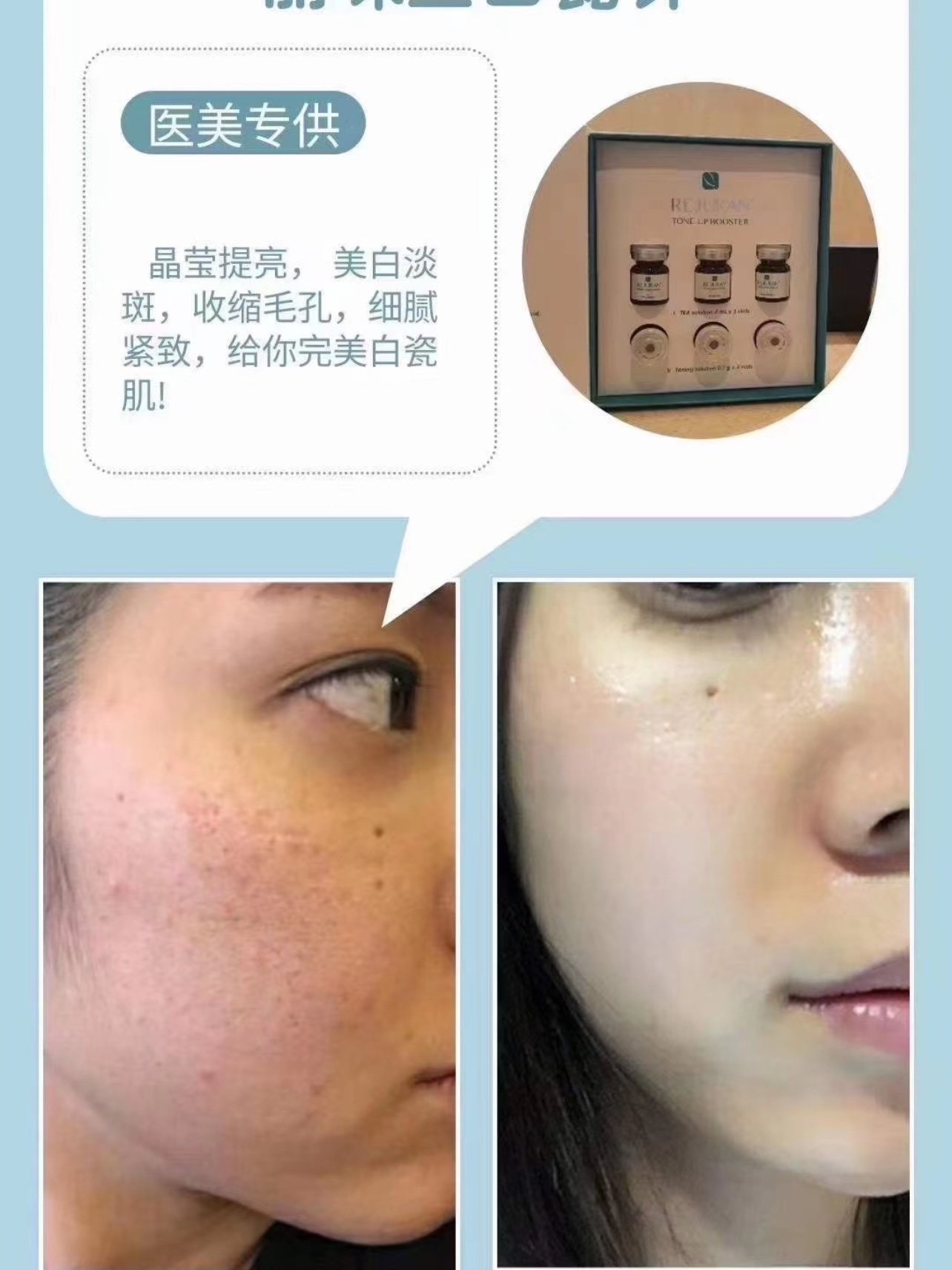 rejuran丽珠兰白瓷针