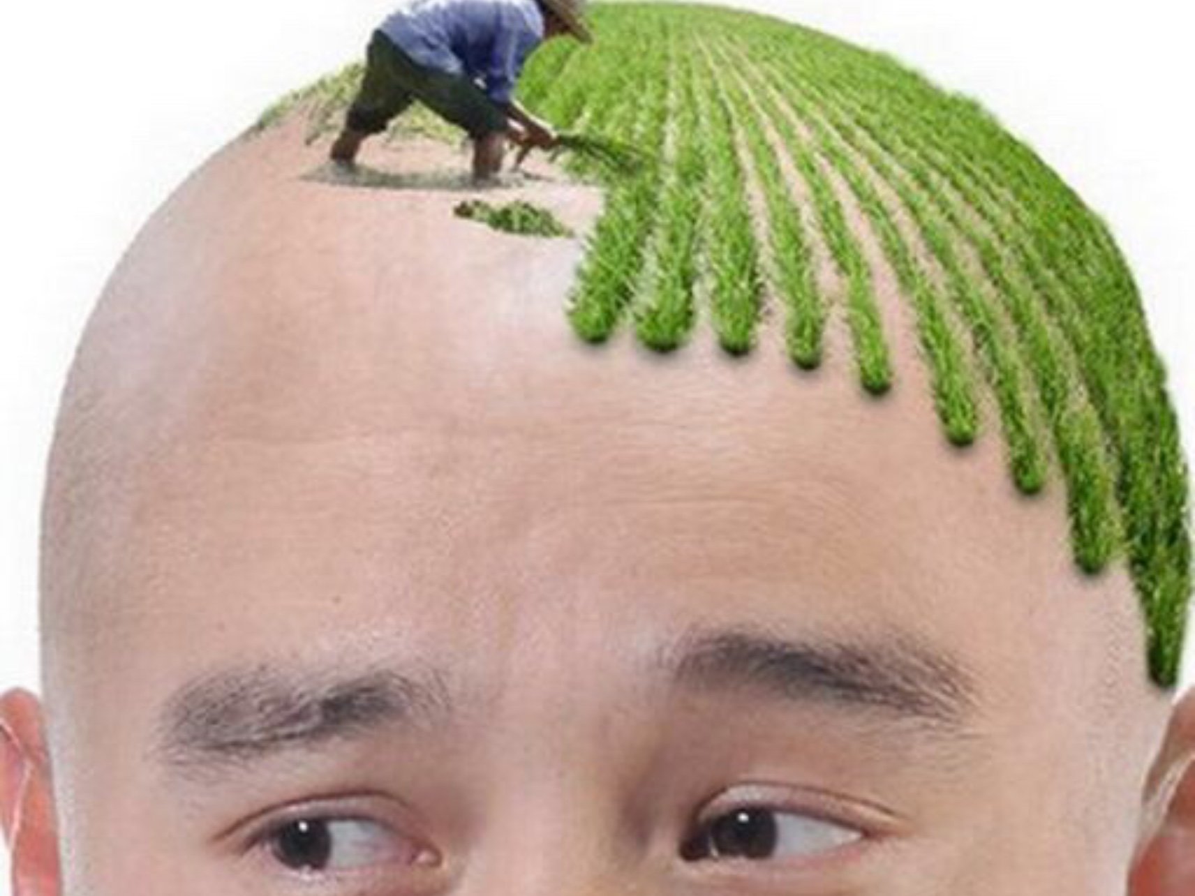 脱发人群最为关心的,5个掉发脱发的问题!